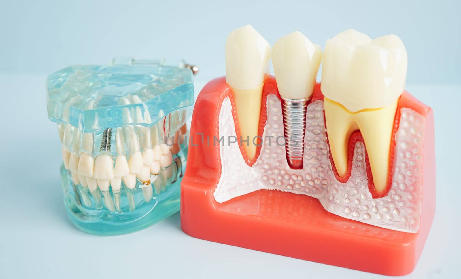 Dental implant, artificial tooth roots into jaw, root canal of dental treatment, gum disease, teeth model for dentist studying about dentistry.