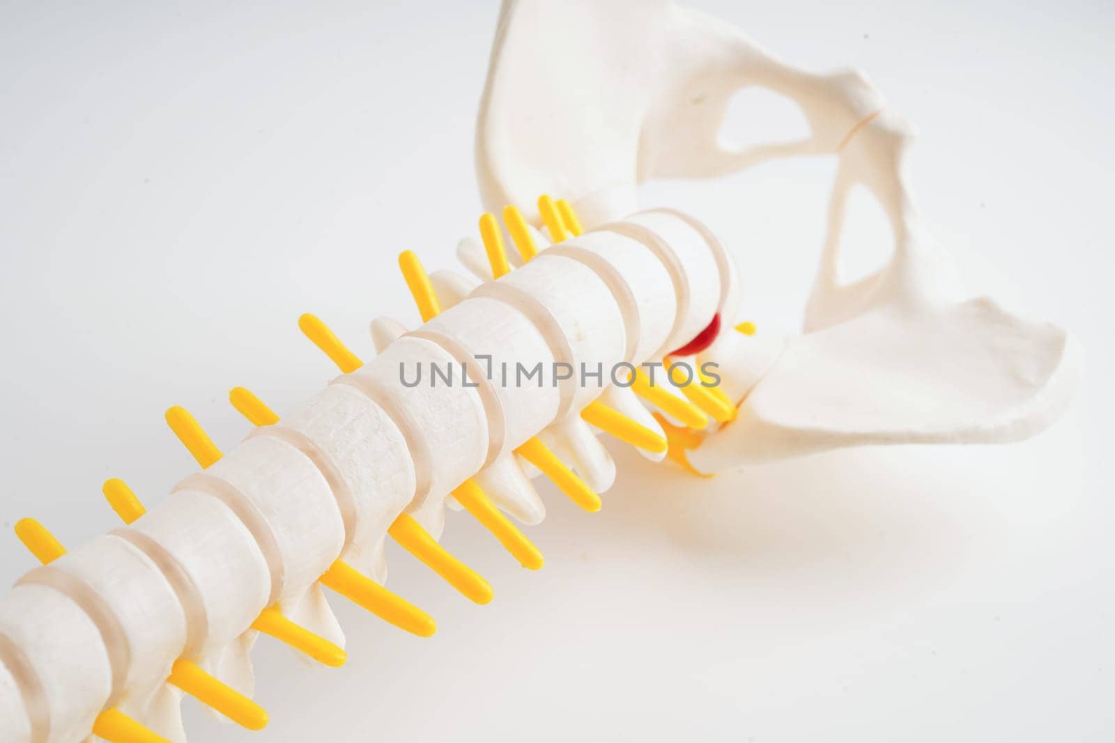Spinal nerve and bone, Lumbar spine displaced herniated disc fragment, Model for treatment medical in the orthopedic department.