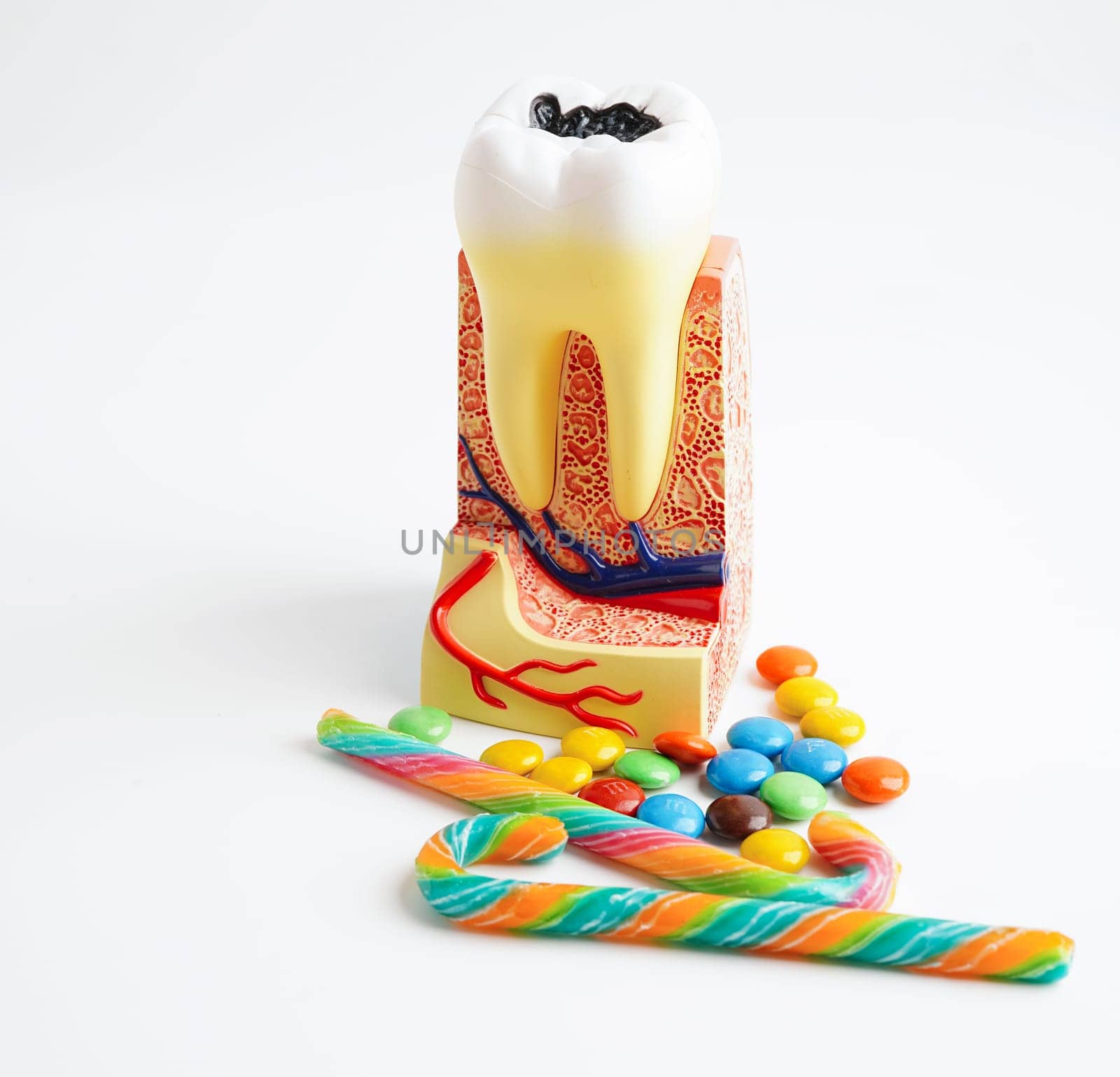 Dental implant, artificial tooth roots into jaw, root canal of dental treatment, gum disease, teeth model for dentist studying about dentistry.