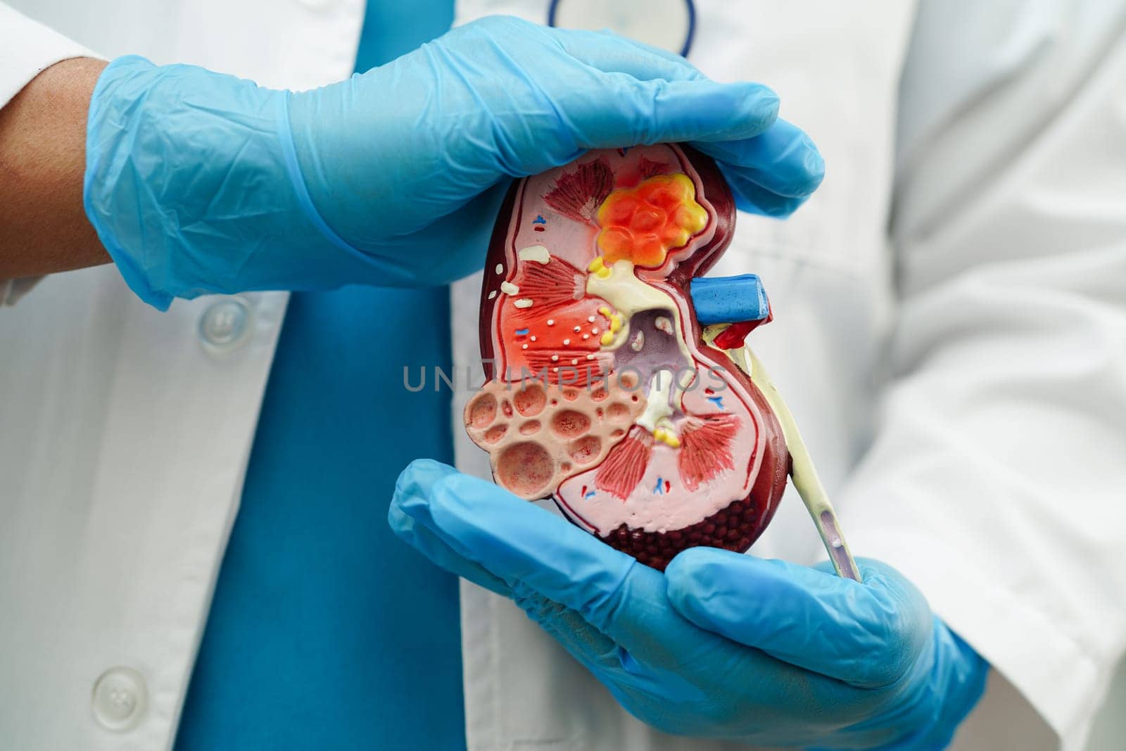 Chronic kidney disease, doctor with model for treatment urinary system, urology, Estimated glomerular filtration rate eGFR.