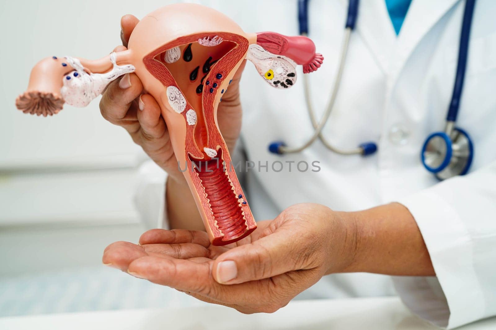Uterus, doctor holding human anatomy model for study diagnosis and treatment in hospital.