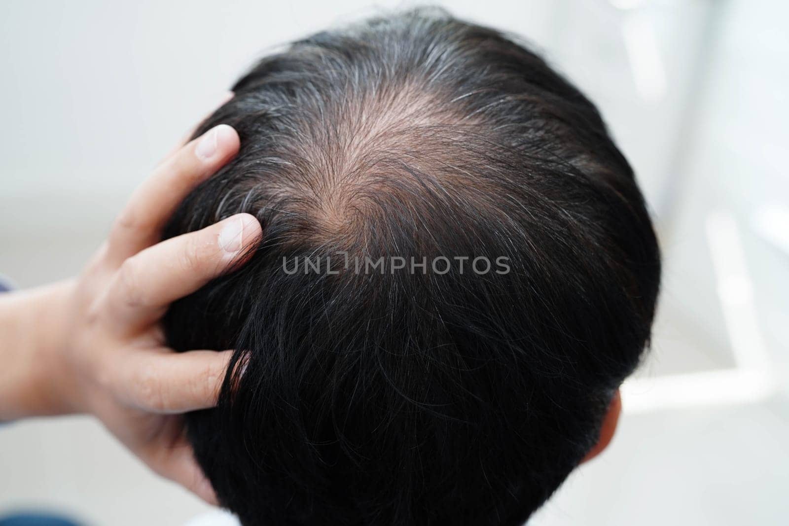 Bald head in man, hair loss treatment health problem.