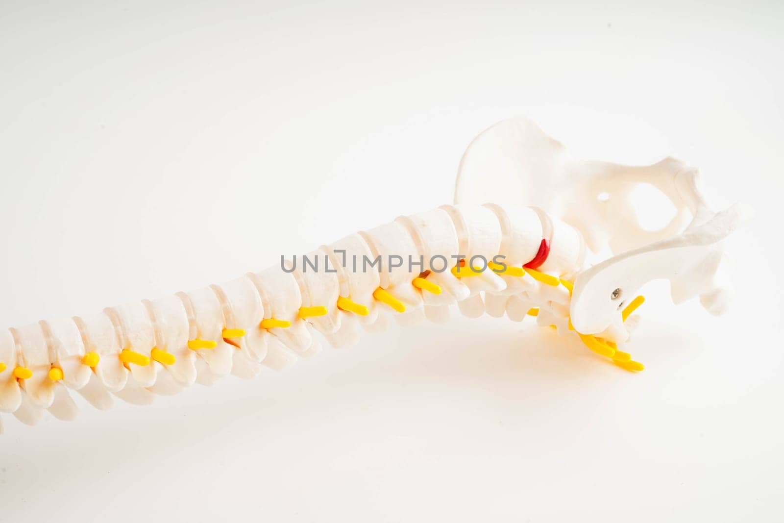 Spinal nerve and bone, Lumbar spine displaced herniated disc fragment, Model for treatment medical in the orthopedic department.
