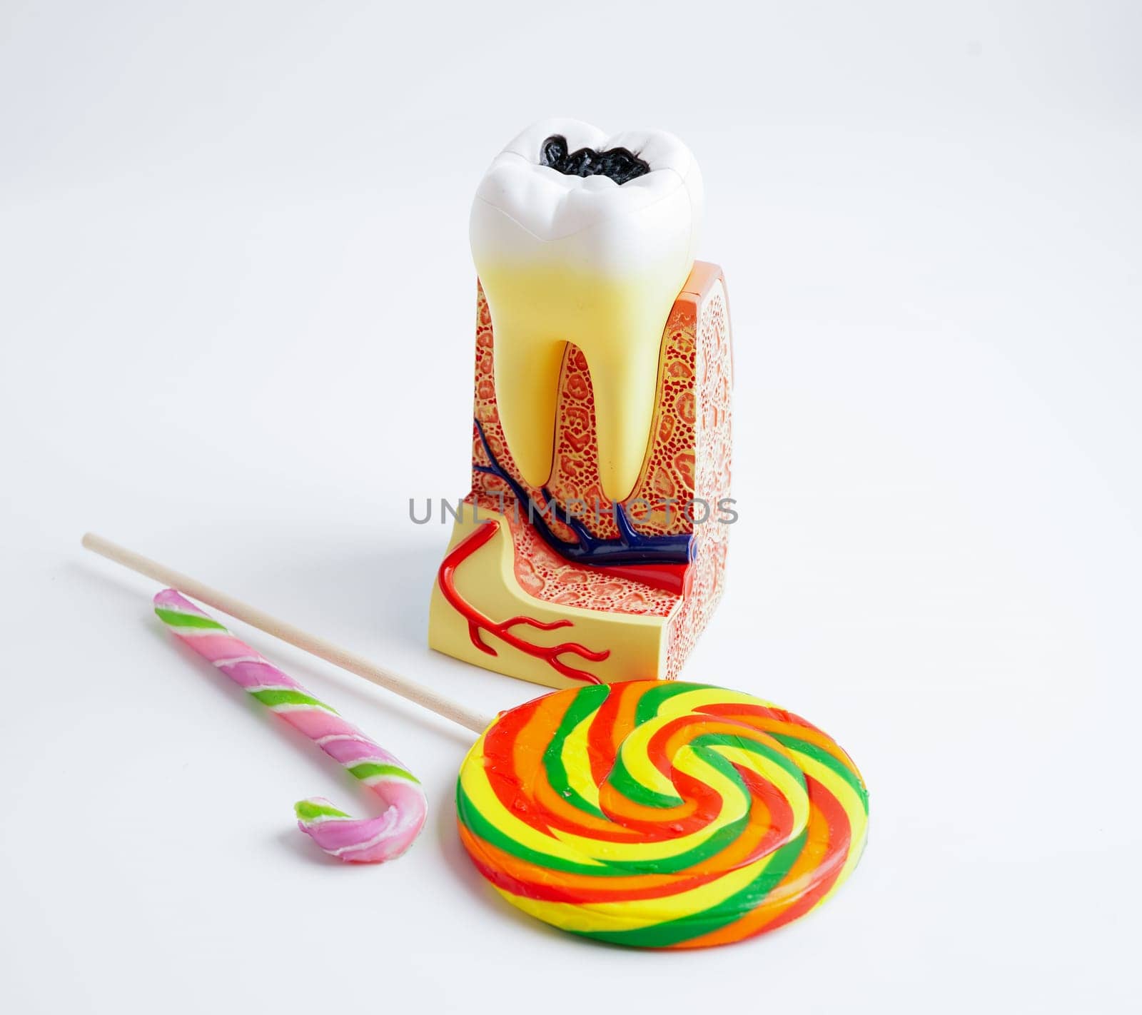 Tooth decay with sweet sugar candy, bad food for dental health care.