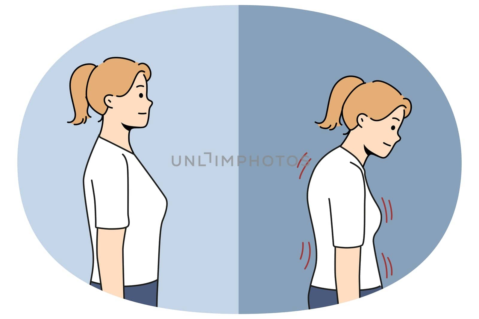Stooped woman before and after correcting posture thanks to massage therapist or chiropractor helping to get rid of scoliosis. Girl with bad posture due to lordosis and kyphosis or spinal defect