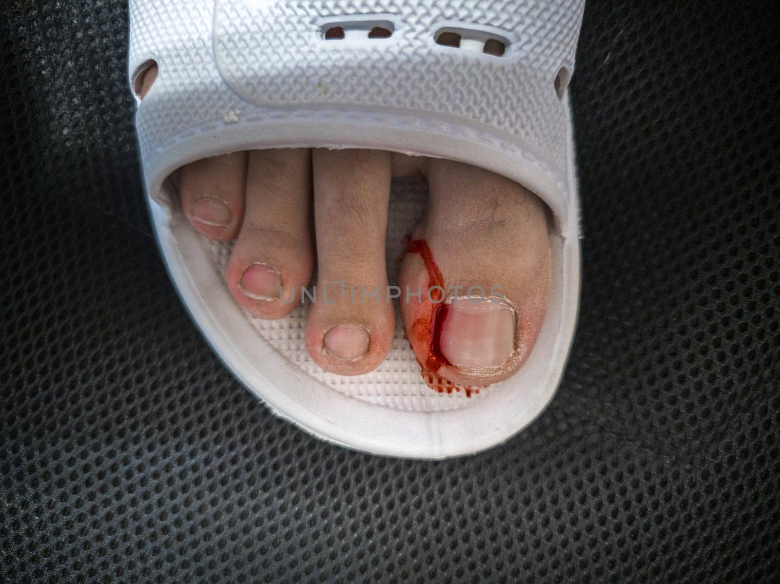 Close-up of a foot in a white plastic slipper with a bleeding toe caused by a torn hangnail. Medical theme highlighting injury, hygiene, and wound care.