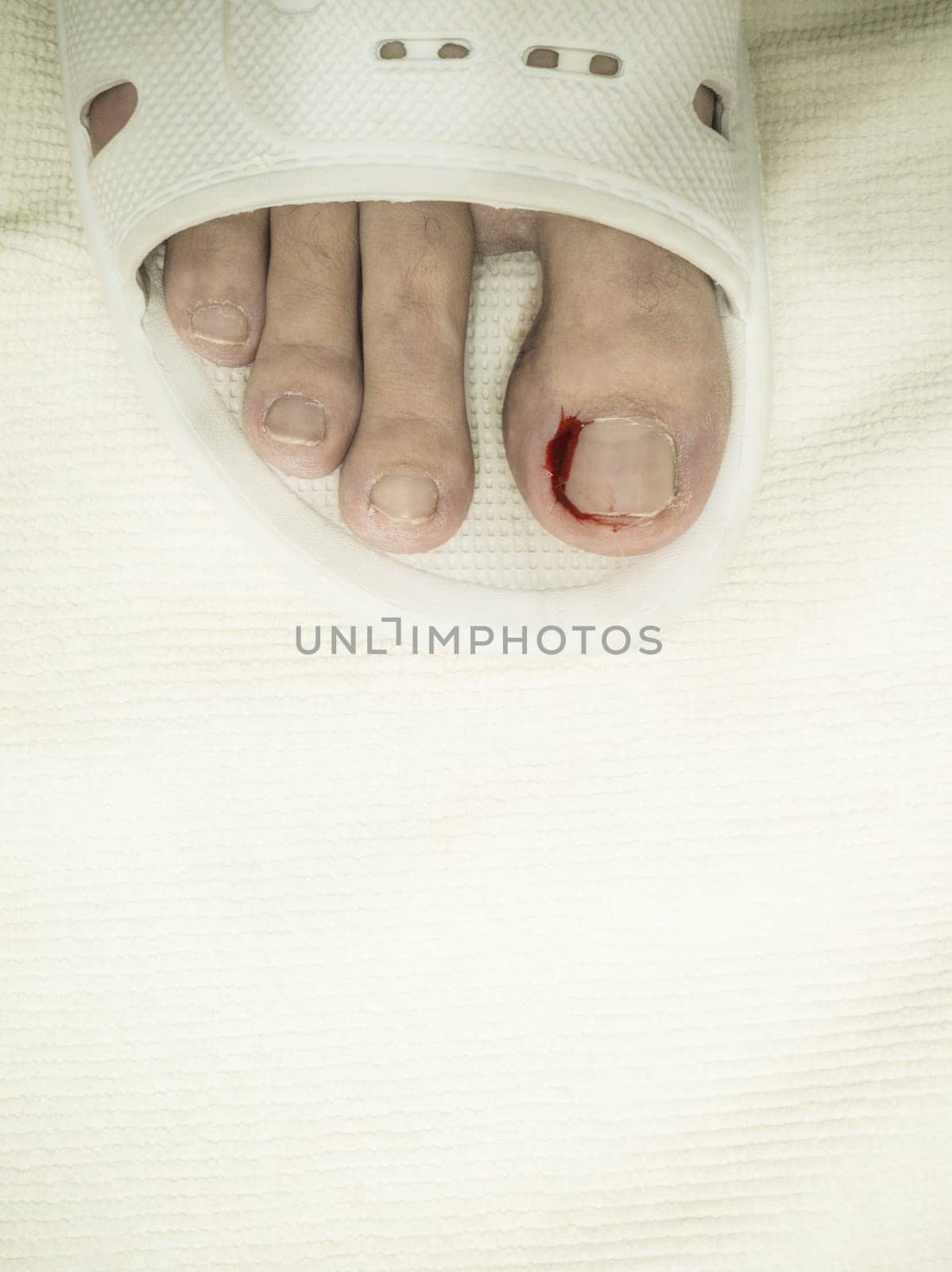 Close-up of a foot in a white plastic slipper with a bleeding toe caused by a torn hangnail. Medical theme highlighting injury, hygiene, and wound care.