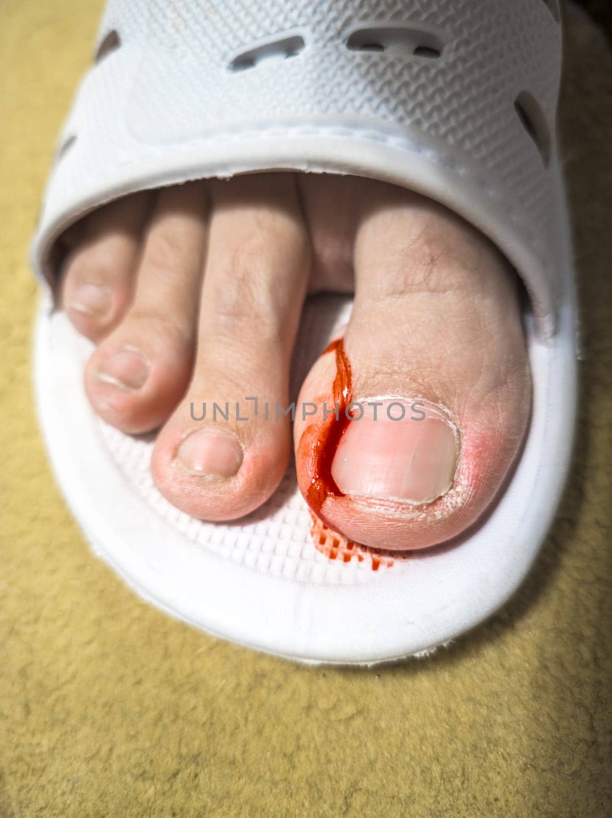 Close-up of a foot in a white plastic slipper with a bleeding toe caused by a torn hangnail. Medical theme highlighting injury, hygiene, and wound care.