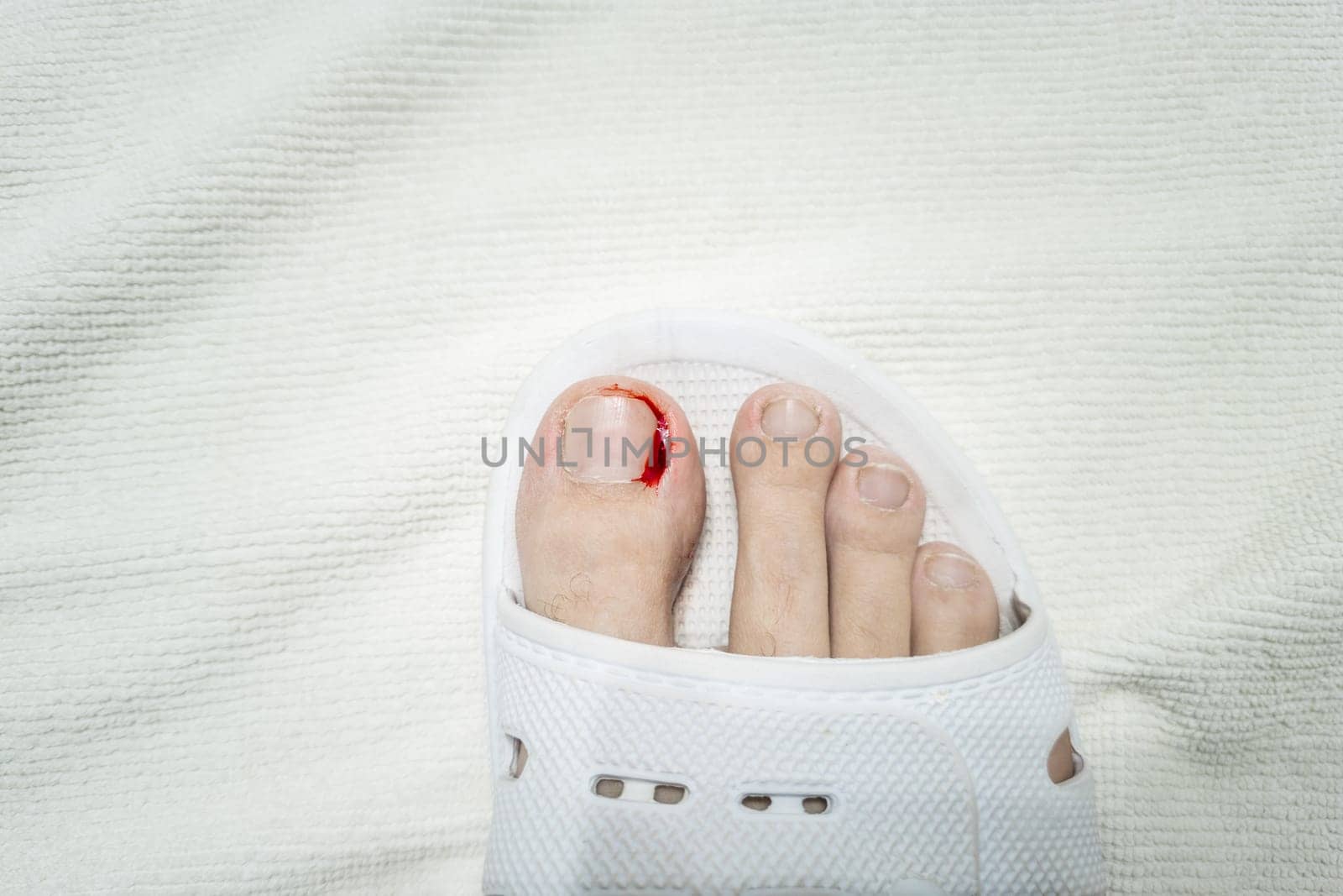 Close-up of a foot in a white plastic slipper with a bleeding toe caused by a torn hangnail. Medical theme highlighting injury, hygiene, and wound care.