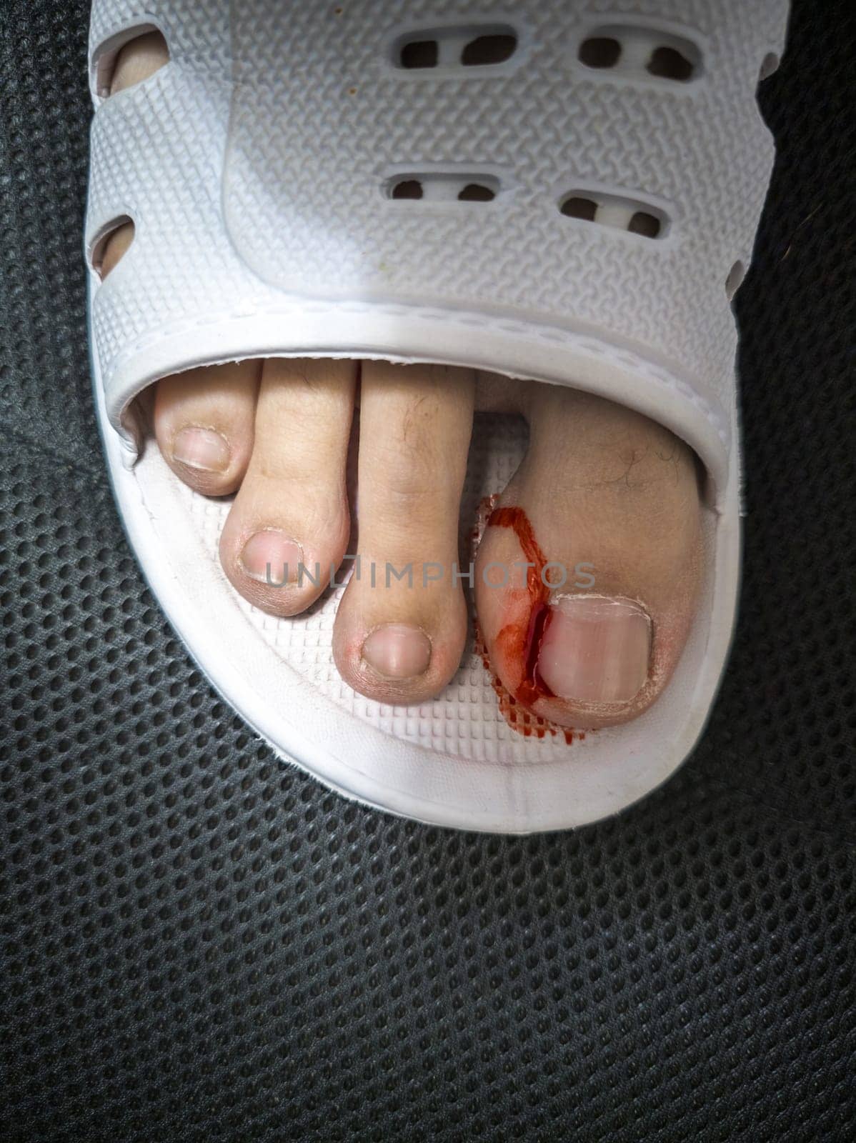 Close-up of a foot in a white plastic slipper with a bleeding toe caused by a torn hangnail. Medical theme highlighting injury, hygiene, and wound care.