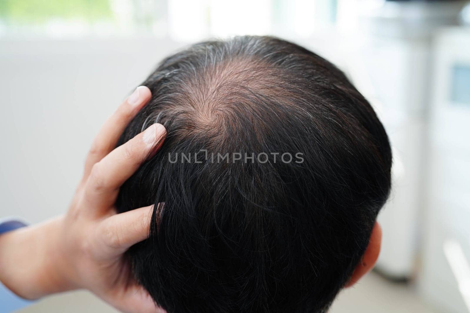 Bald head in man, hair loss treatment health problem.