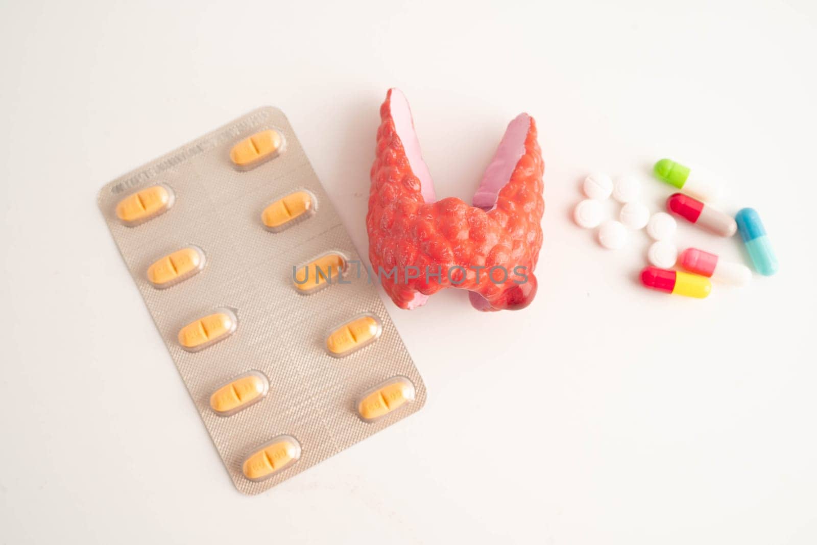 Thyroid model with pill drug treatment, Hyperthyroidism, Overactive or Lymphoma.