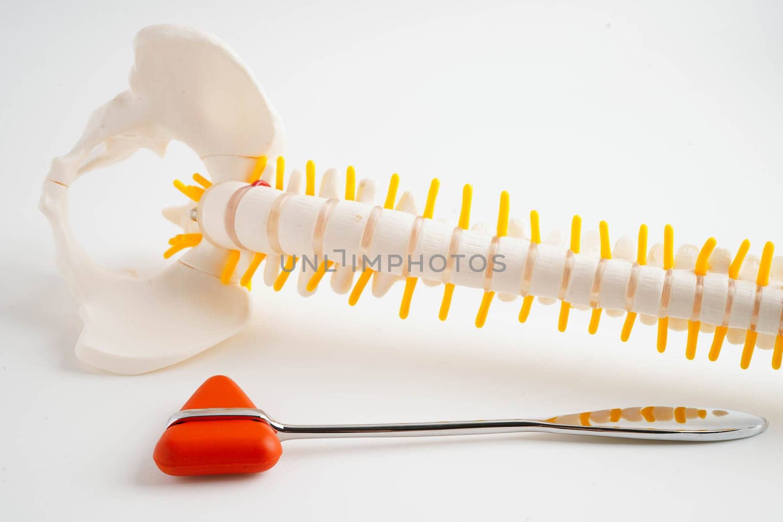 Spinal nerve and bone with knee reflex hammer, Lumbar spine displaced herniated disc fragment, Model for treatment medical in the orthopedic department.