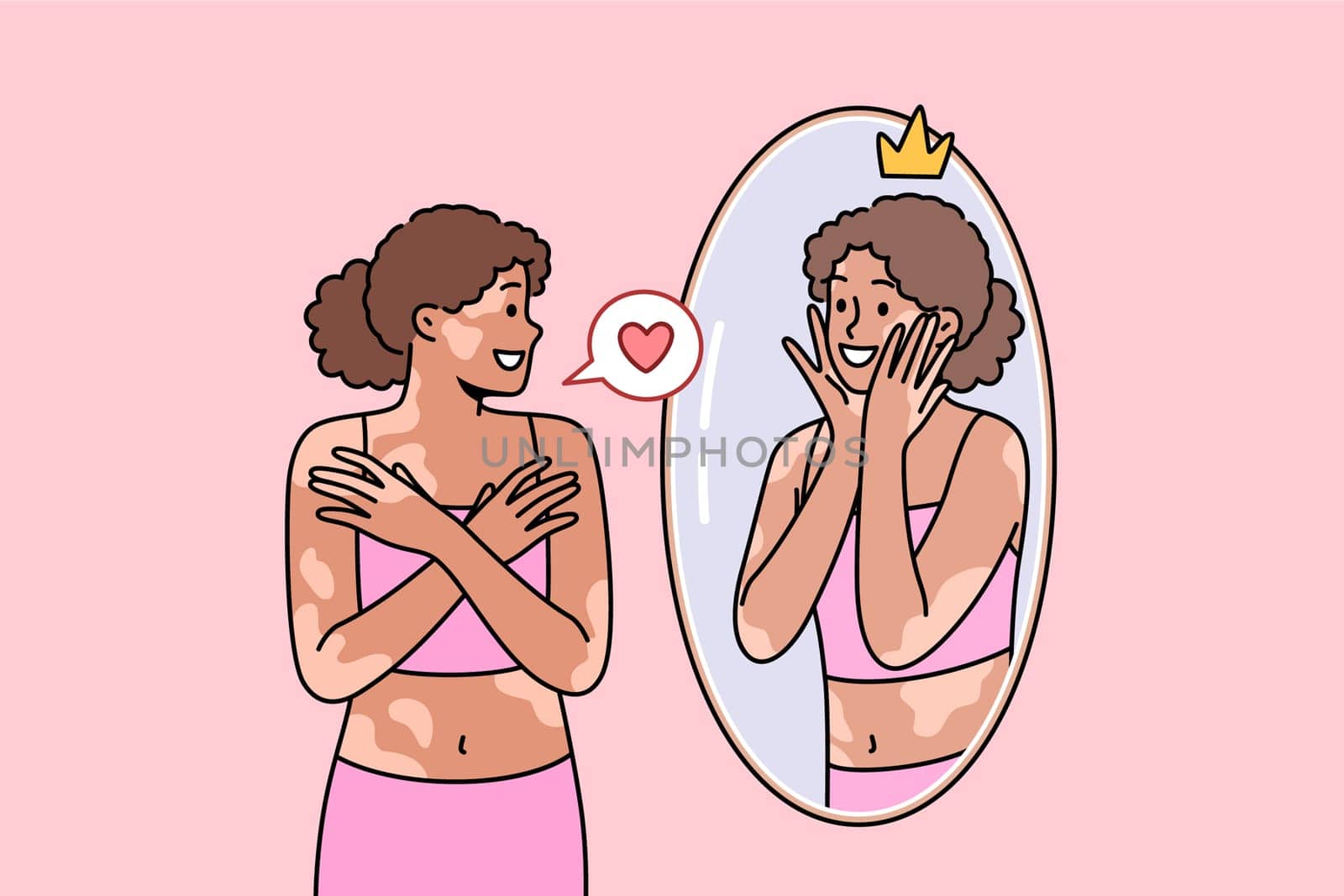 Woman with vitiligo syndrome or spots on skin looks in mirror and smiles, accepting herself as she is. Ethnic girl with high self-esteem and vitiligo disease feels sympathy for own reflection