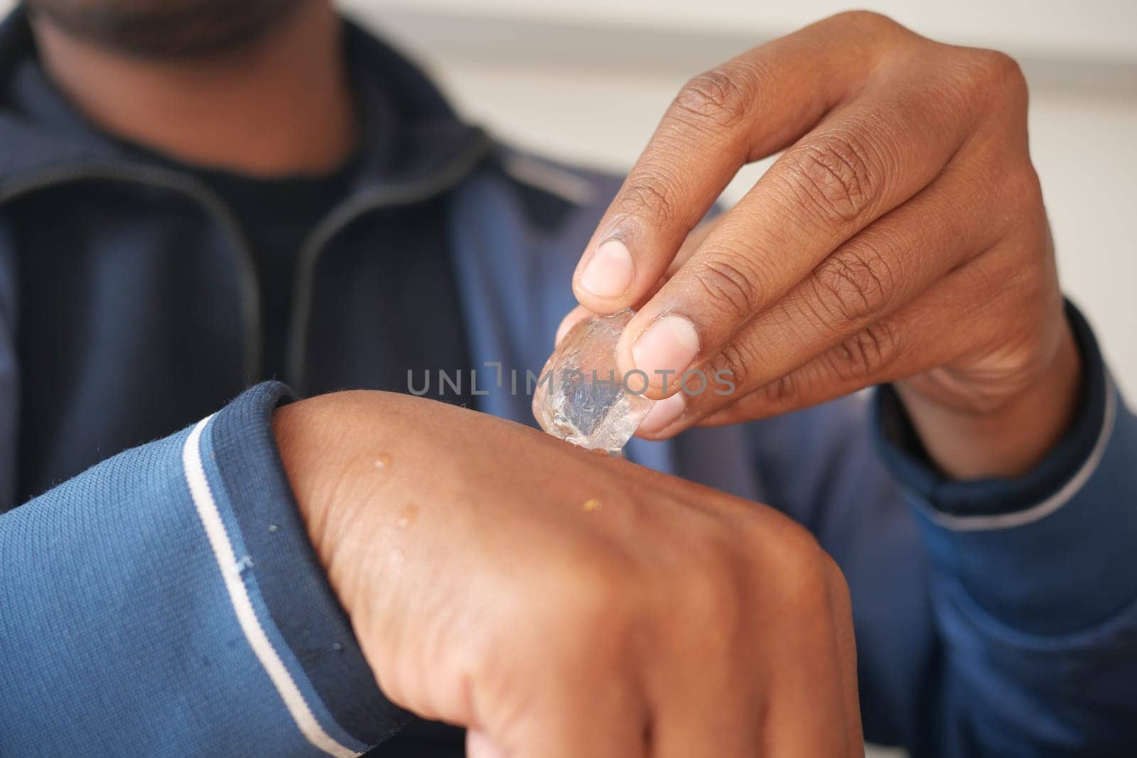 A person using ice to cool and relieve skin discomfort at home.