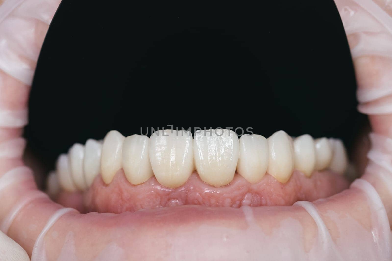Closeup photo with zirconium artificial teeth. Zirconium crowns.