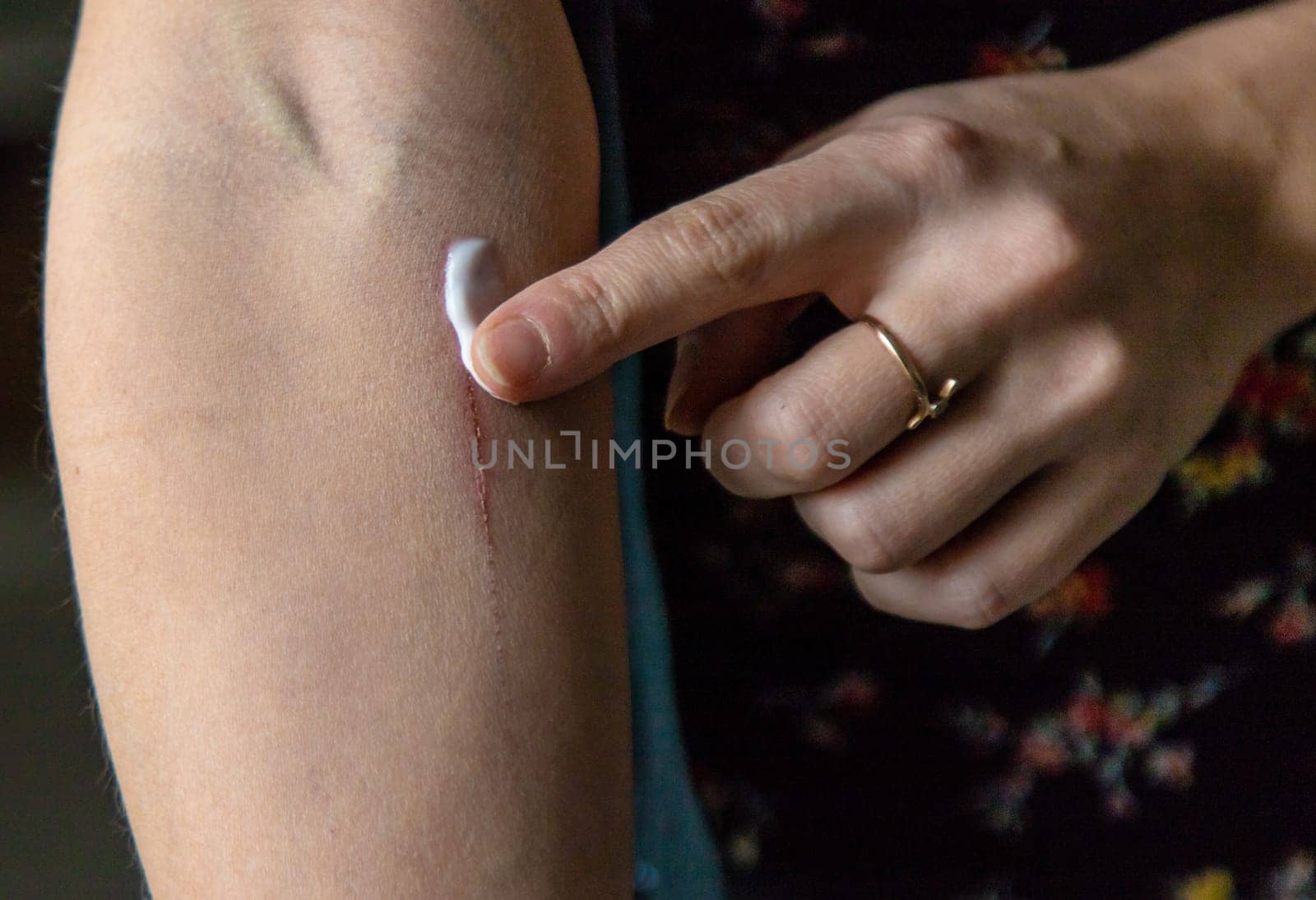 A scratch on a woman hand. Selective focus. people.