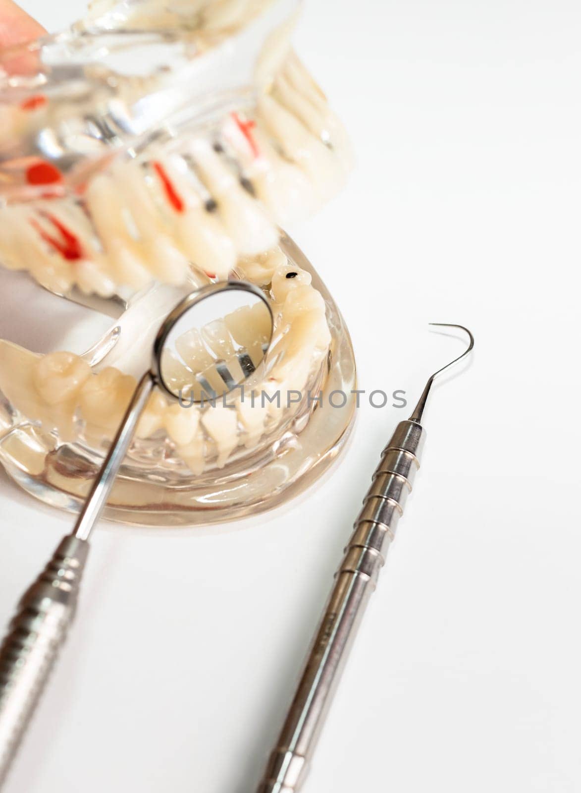 Dental Concept. Basic Dental Instruments Set, Mirror, Explorer, Anatomical Teeth Model. Oral Hygiene , Dental Care. Transparent Disease Tooth Model with Implant Bridge. Vertical. High quality photo
