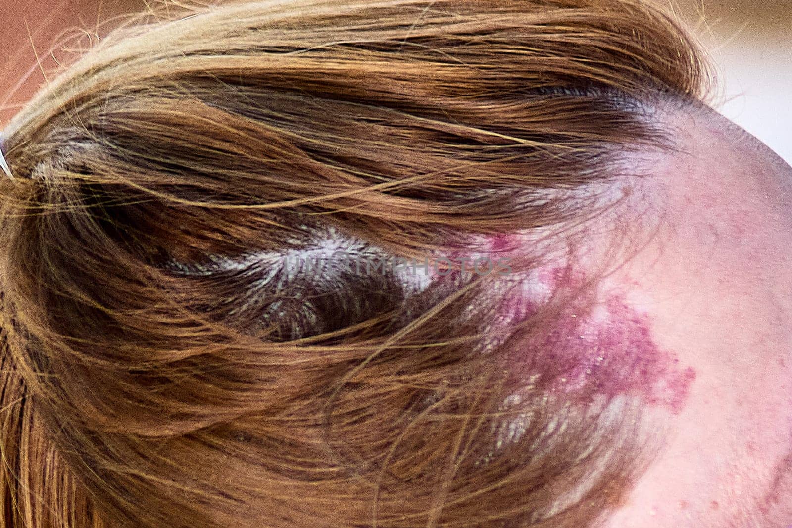 A birthmark located near the forehead on the scalp, partially covered by light brown hair. The reddish mark has an irregular shape and appears distinct on the skin beneath the hair, adding a personal and unique feature.