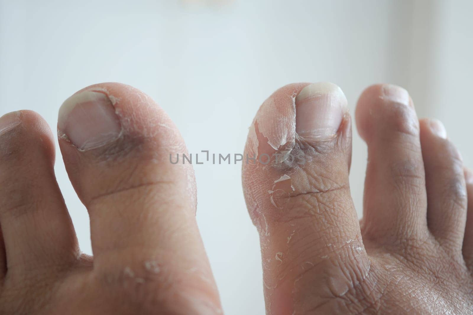 Close-up of dry and cracked toes highlighting health concerns and care.