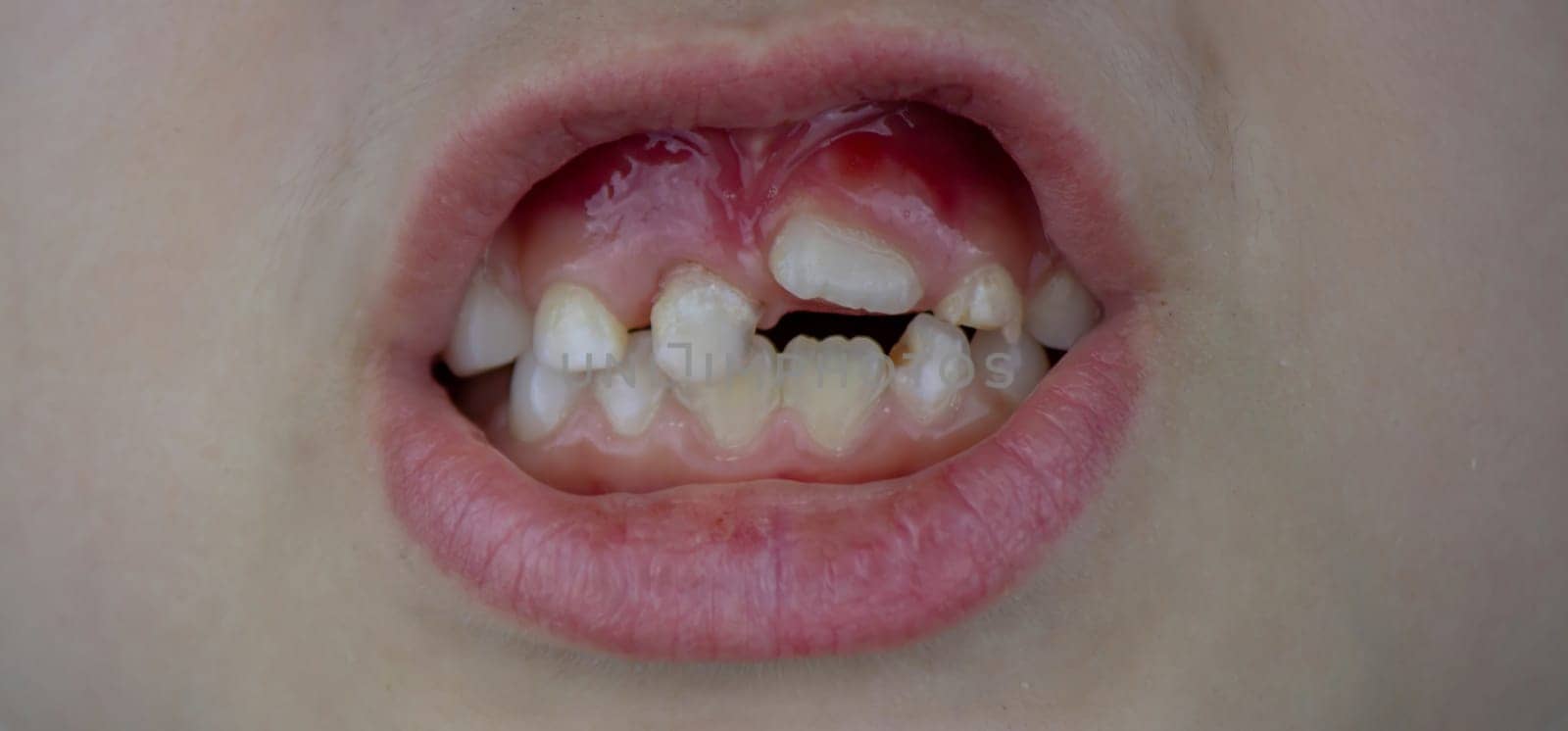 Close-up of unhealthy baby teeth. Sick teeth in a child. Portrait of a boy with sick teeth.