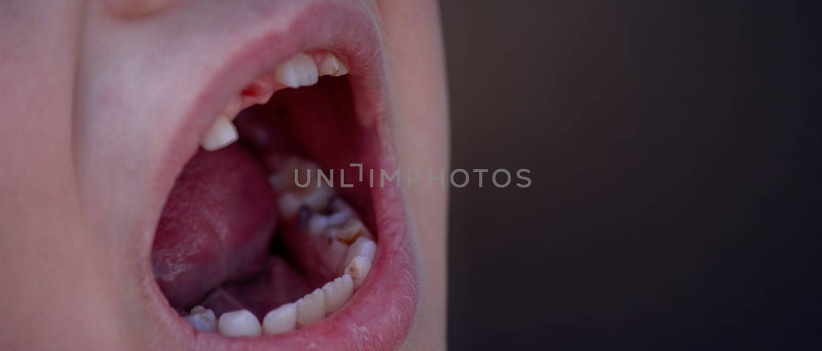 Close-up of unhealthy baby teeth. Sick teeth in a child. Portrait of a boy with sick teeth.
