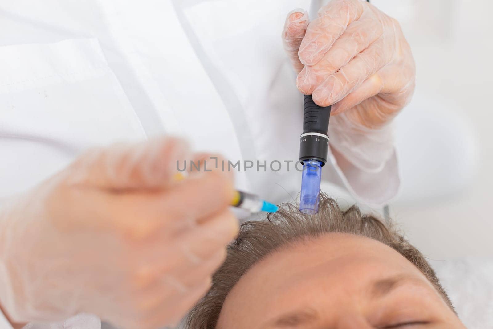 Alopecia. Man hair loss improve growth treatment regeneration, dermapen microneedling, vitamin exosomes plasma injections. Trichologist cosmetologist doctor head scalp procedure fractional mesotherapy