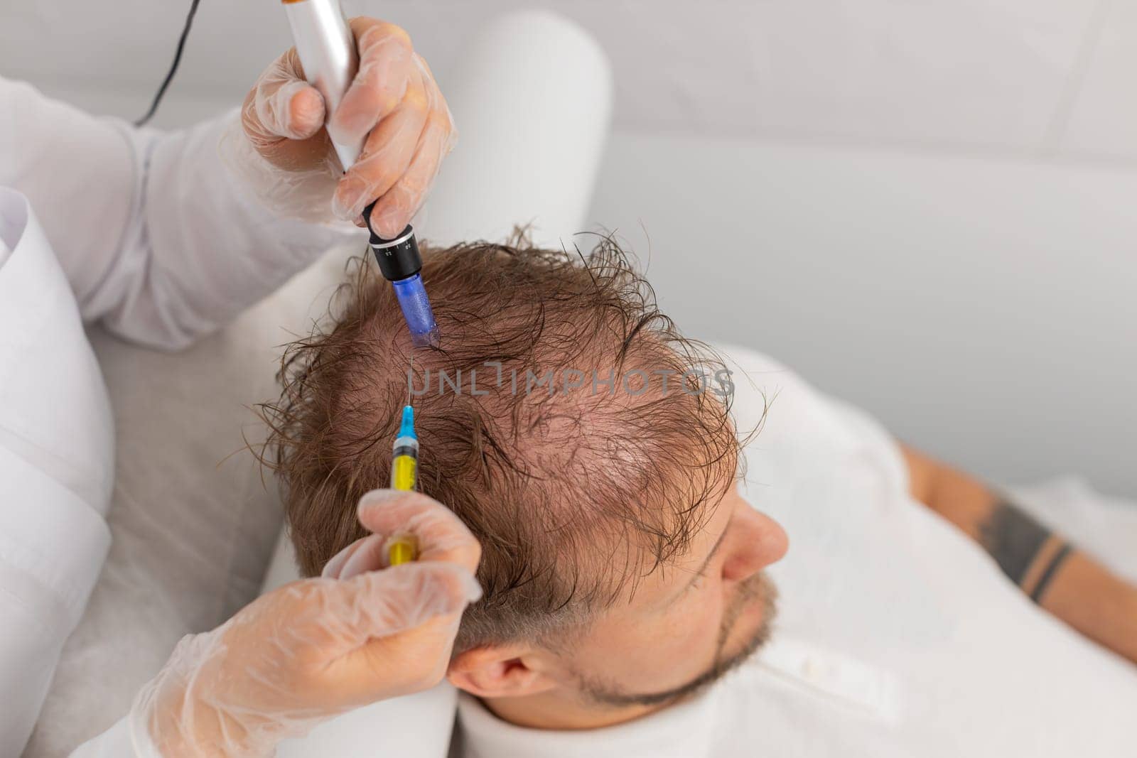 Alopecia. Man hair loss improve growth treatment regeneration, dermapen microneedling, vitamin exosomes plasma serum syringe injections. Trichologist doctor head scalp procedure fractional mesotherapy