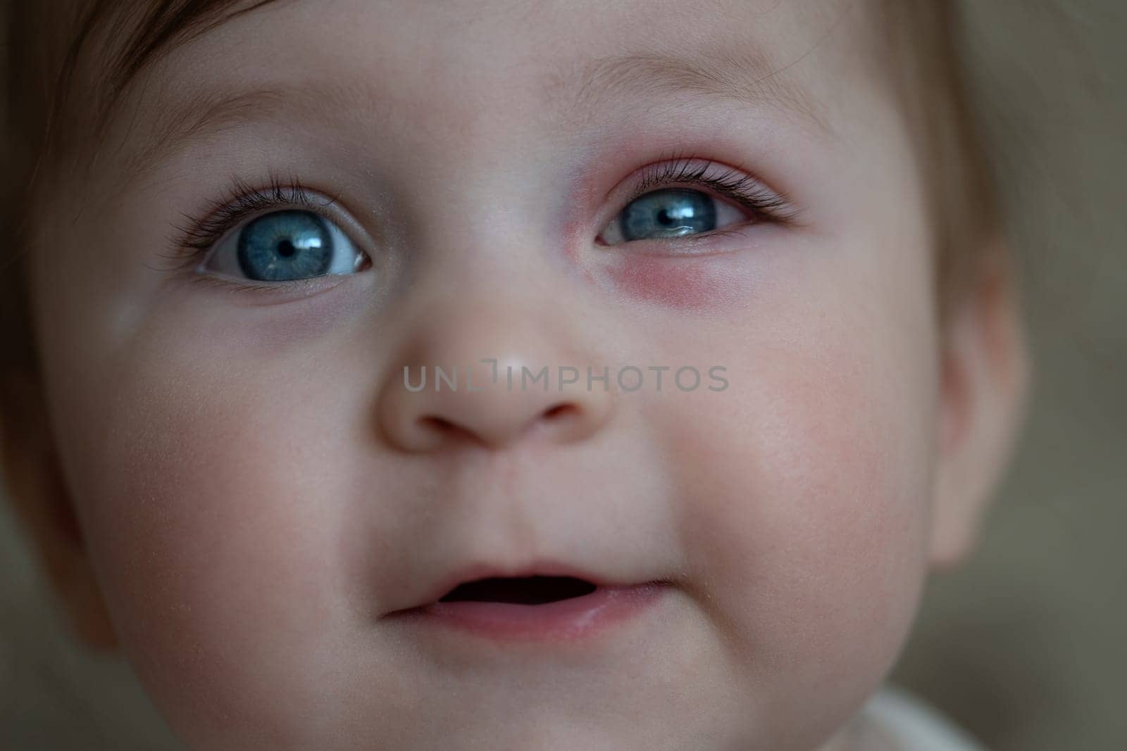 Close up of baby with bacterial purulence conjunctivitis, also known as pink eye. Eye infection. High quality photo