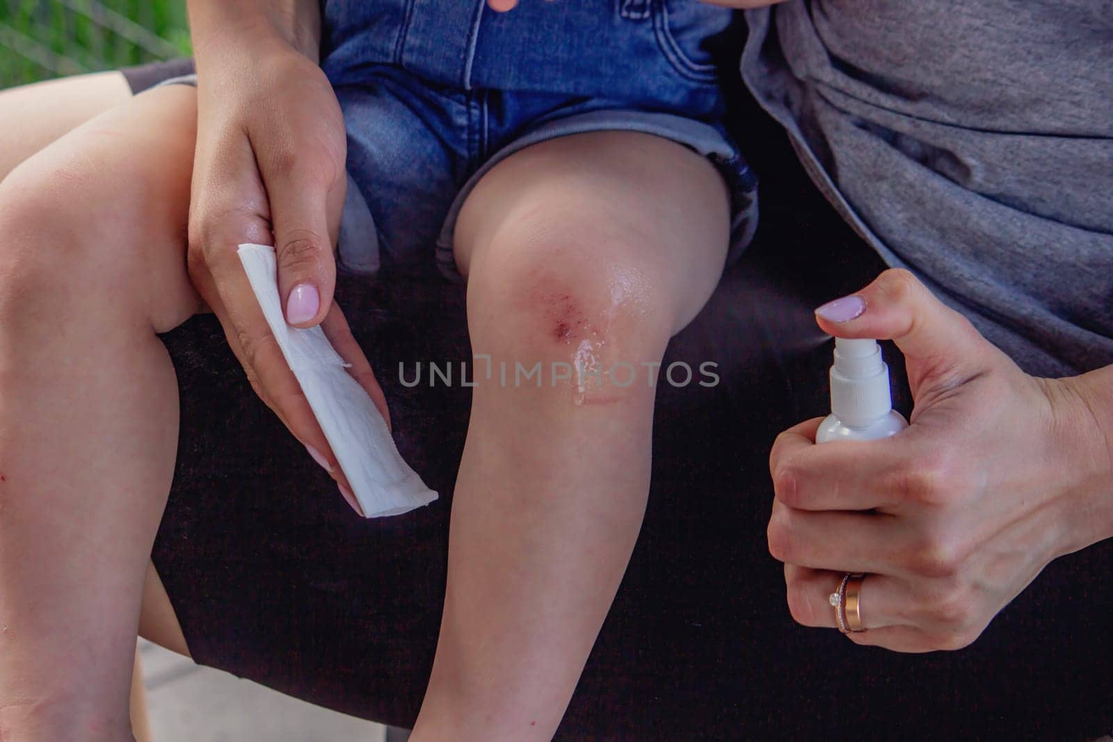 Scratches on a child's leg. small child
