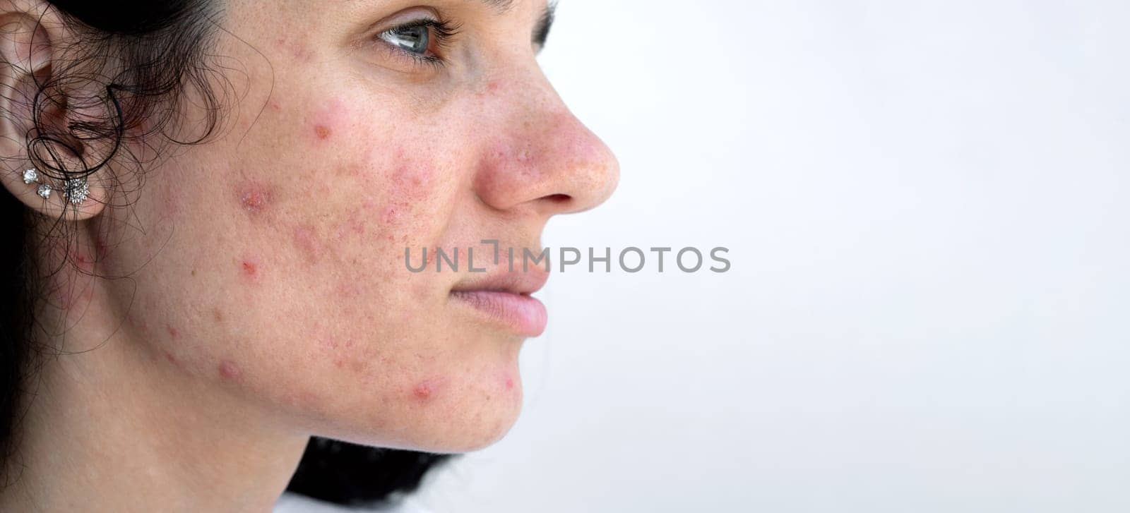 young female face of girl with acne and pimples on skin with problem on isolated white background