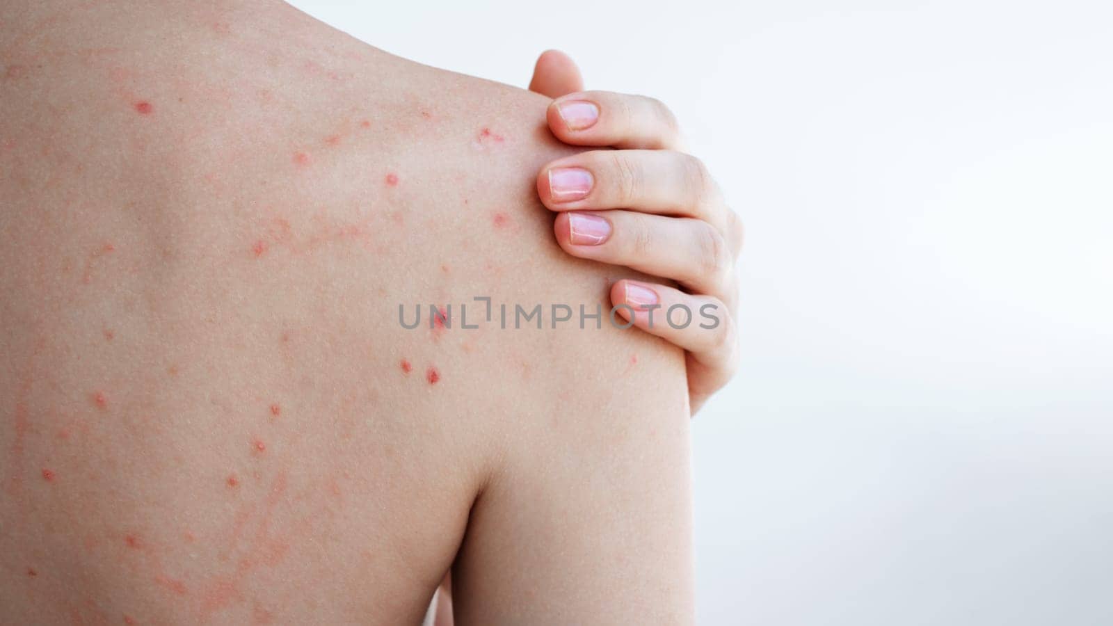 female back and shoulders of woman with pimples and acne on skin on a white isolated background. The body of a girl with problematic skin close-up