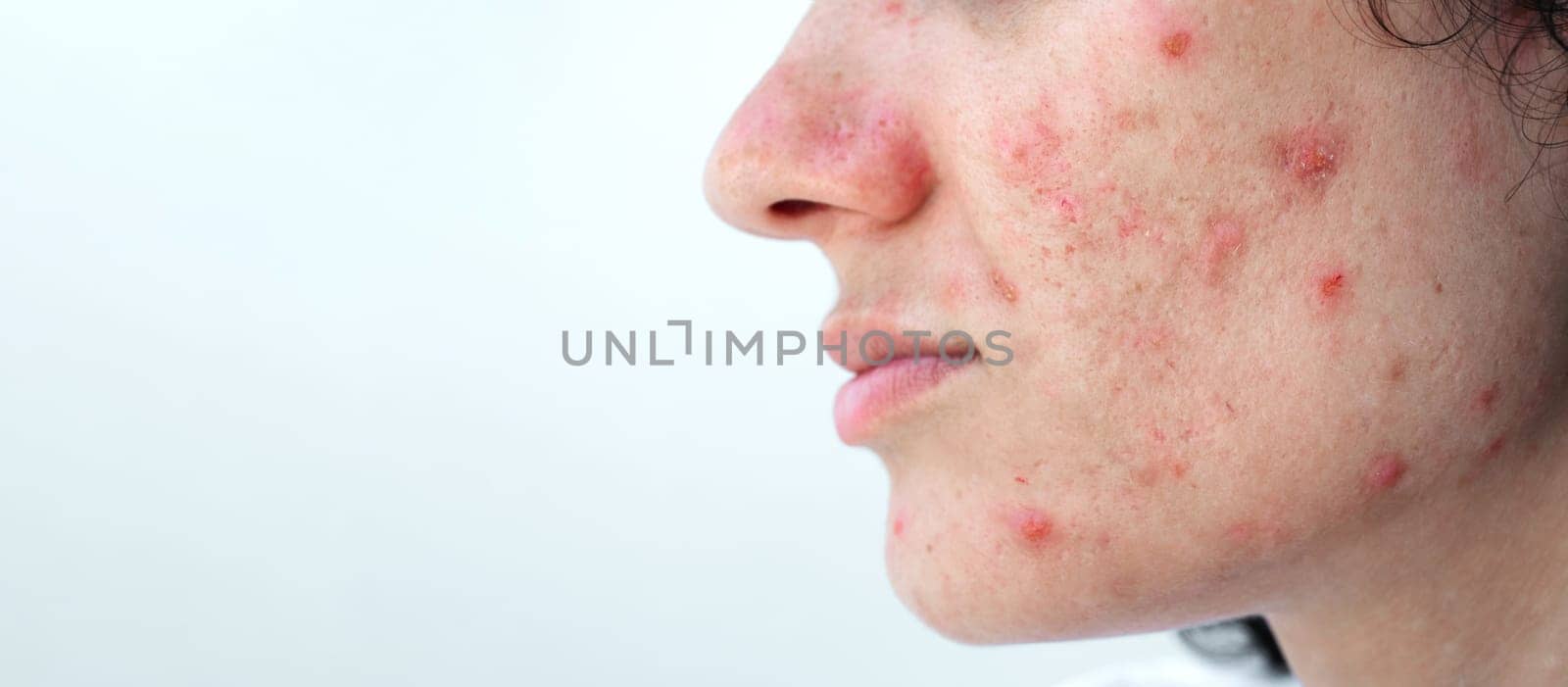 female face of a young woman with acne and pimples on skin with problem close-up on isolated white background