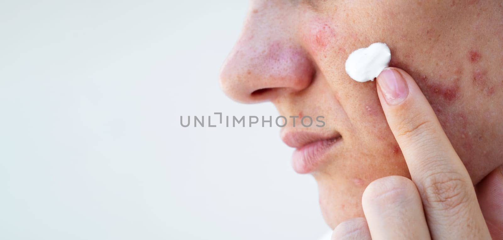 young woman applies acne cream on female face with pimples. Girl with problematic skin in closeup on an isolated white background