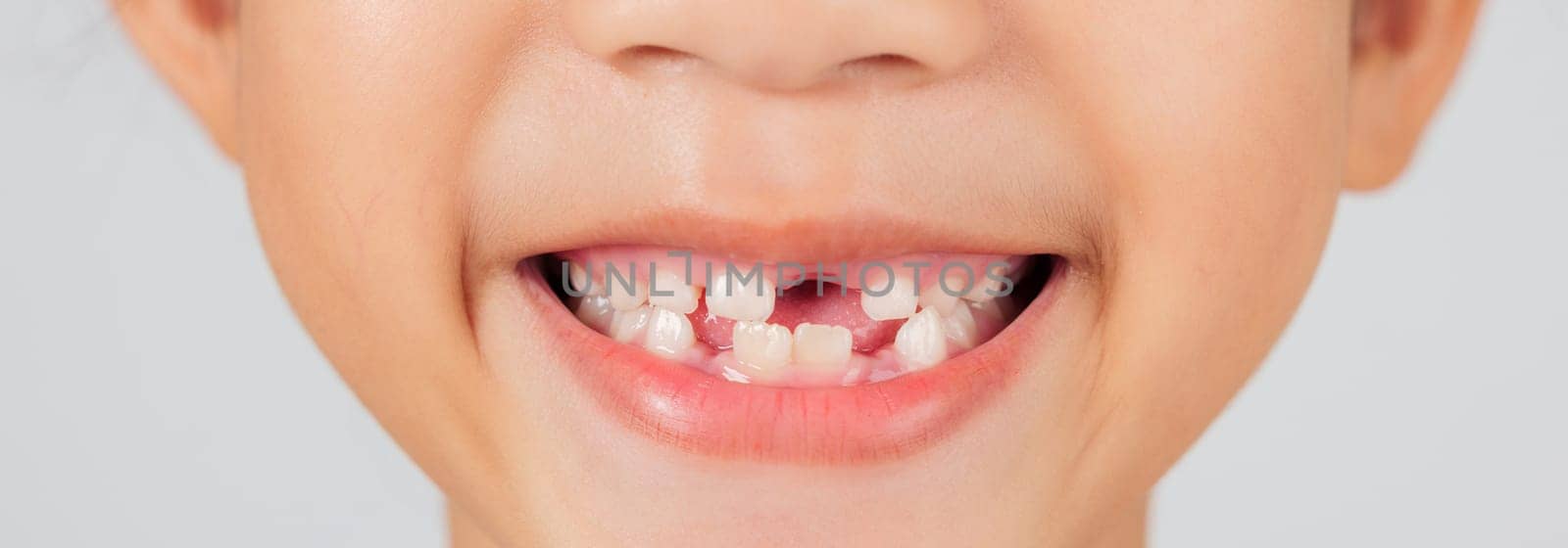 A happy child with a missing tooth smiles brightly. The dentist educates on tooth loss, helping parents understand the natural stages of baby teeth falling out. closeup