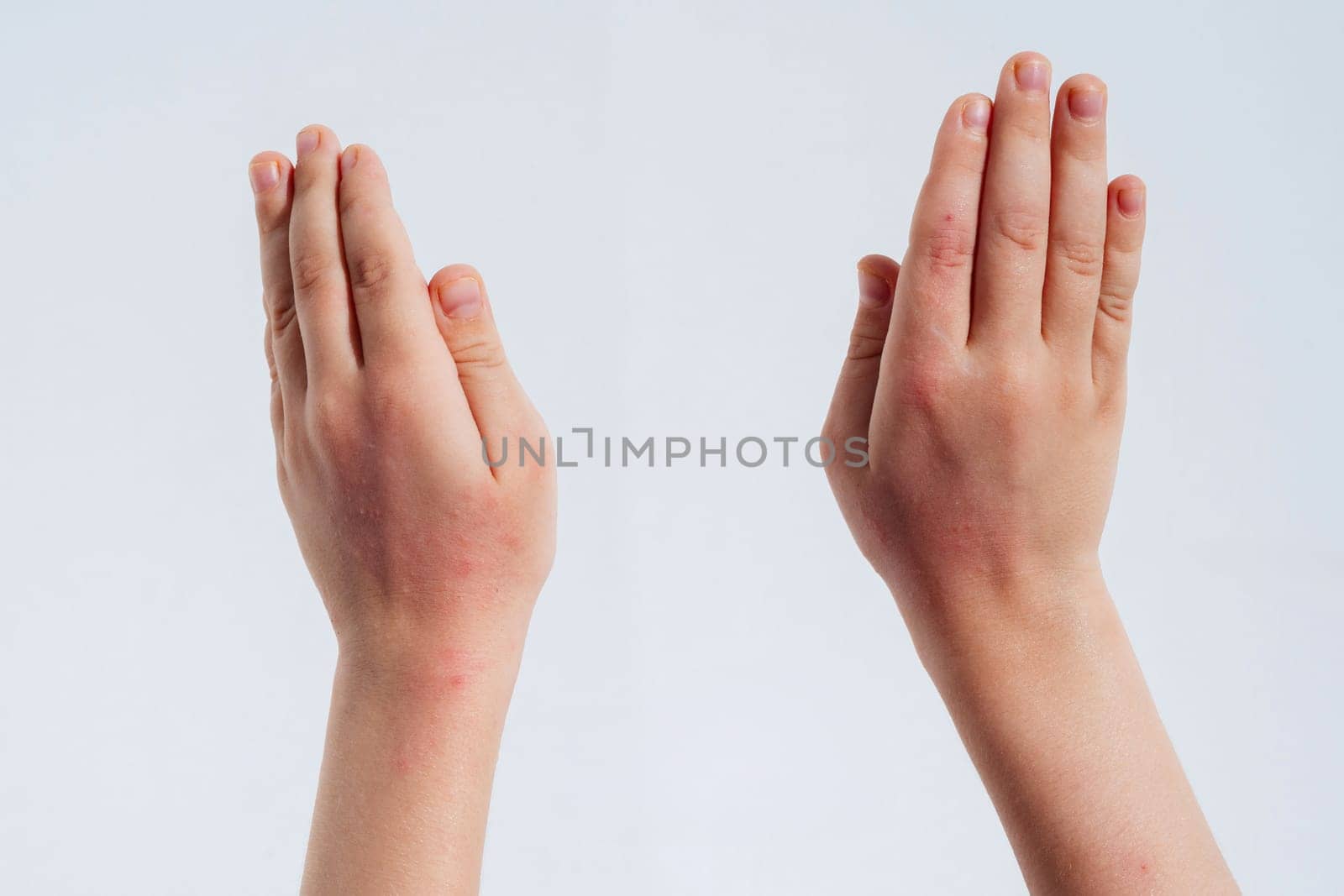 Red rashes from Coxsackie virus on a child hands on a white background. Chickenpox allergy symptoms on children's skin close-up
