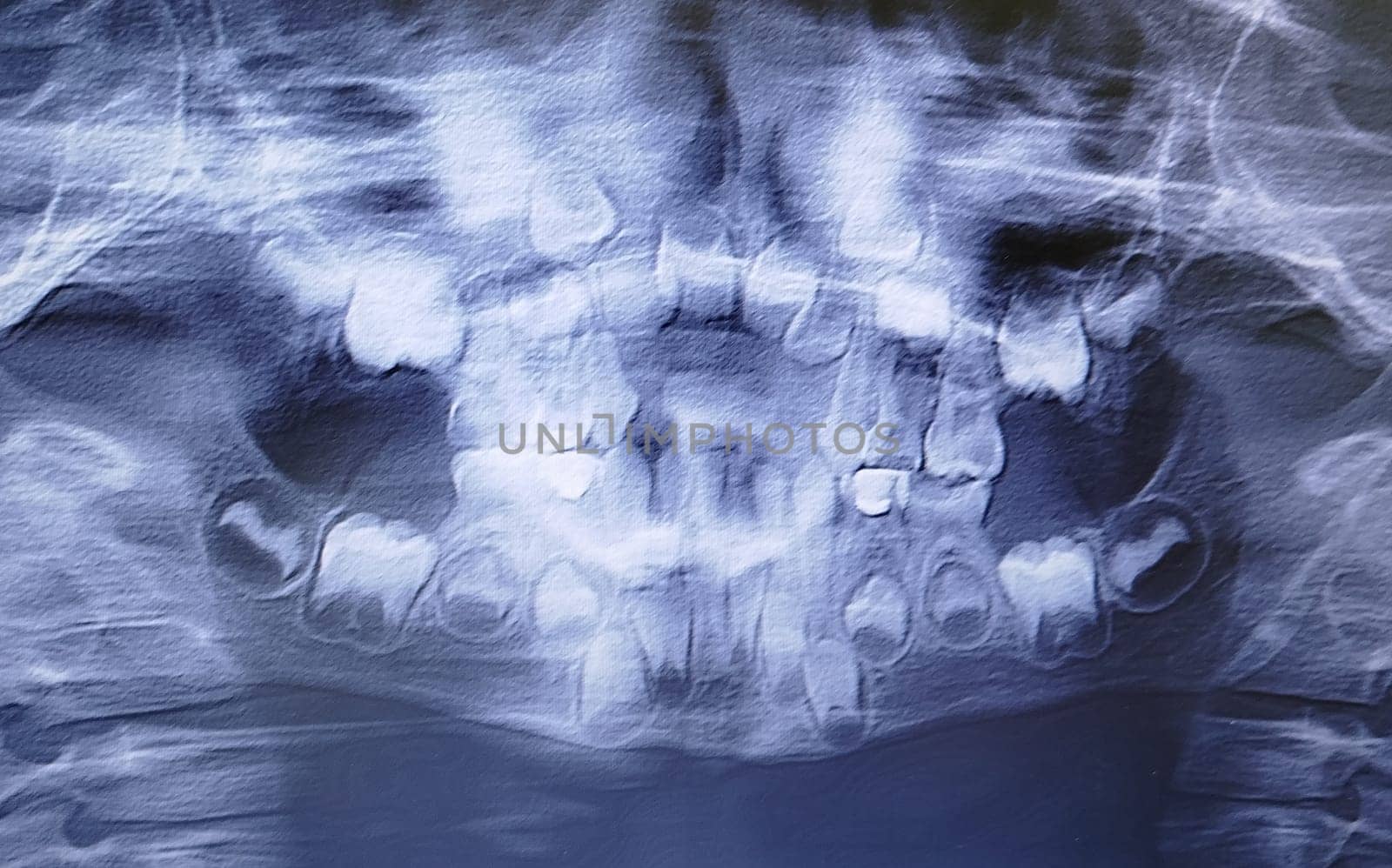A full mouth X-ray displays the teeth and jawbone structure of a child, showing permanent teeth erupting behind the existing baby teeth. Dental development is visible.