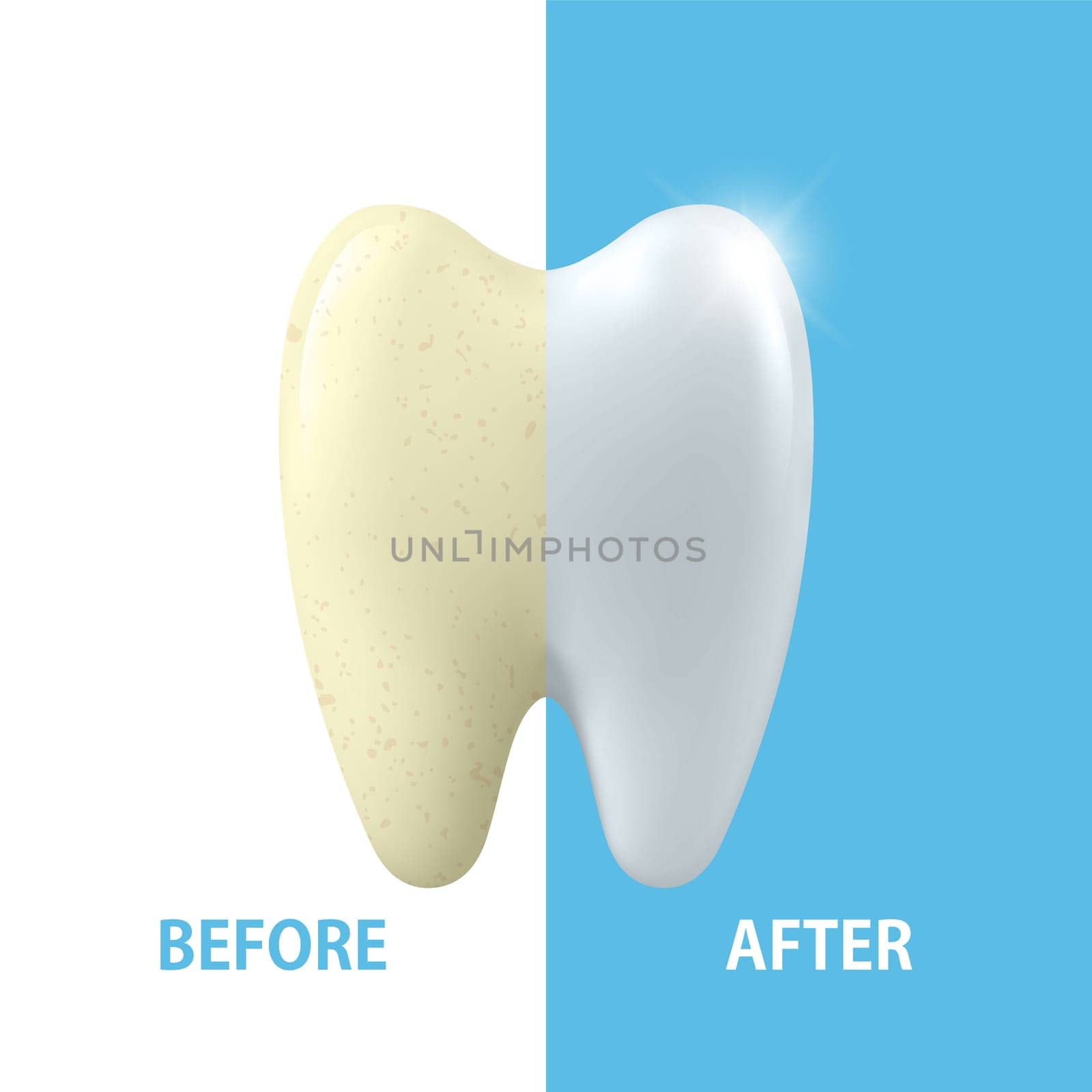 Vector Banner with 3d Realistic Tooth Closeup. Cleaning Concept - Before and After Hygienic Teeth Cleaning. Dentistry Design. Medical, Toothpaste Advertisement. Healthy Oral Hygiene, Teeth Whitening.