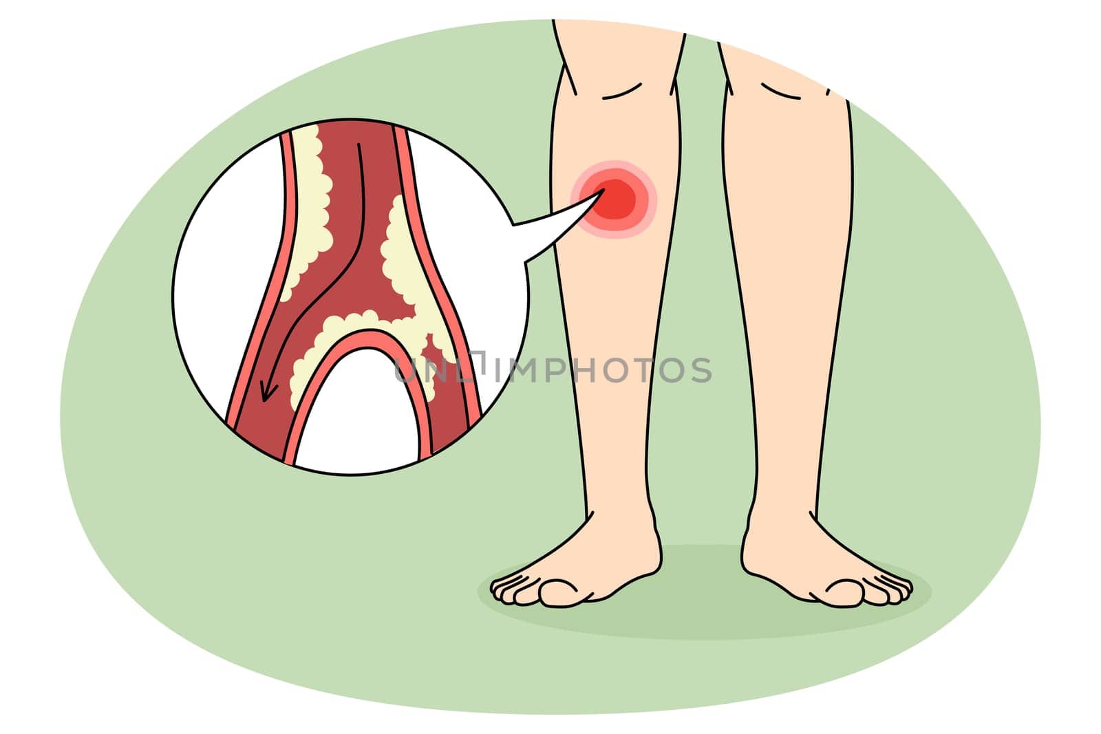 Close up of person suffer from PAD disease having blood vessel blockage in legs. Man struggle with clotted limbs from veins narrowing or blocking. Healthcare concept. Vector illustration.