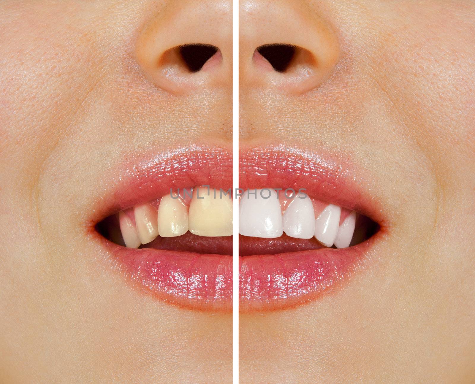 teeth before and after whitening by ssuaphoto