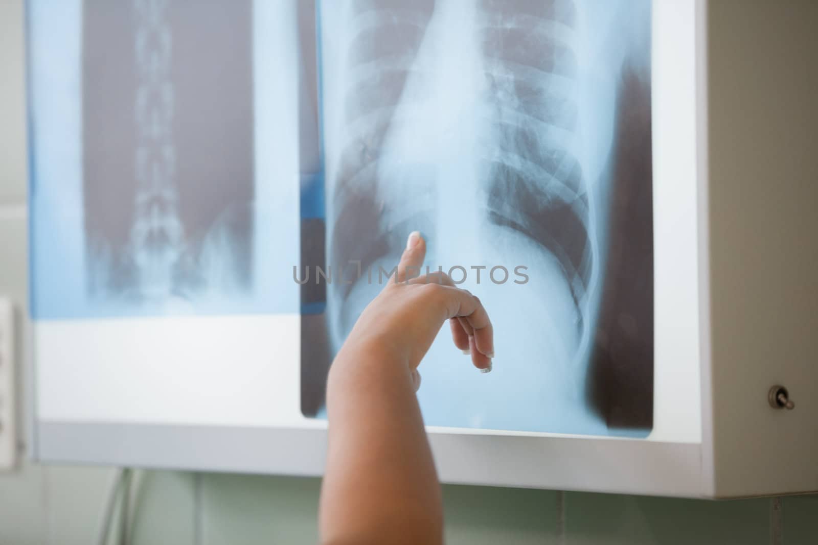 Close up of people showing a X-ray in operating theater