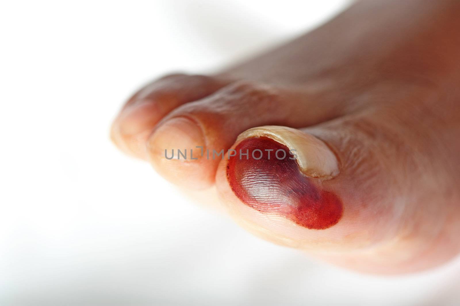 Dry gangrene is seen affecting the big toe of a diabetic patient.