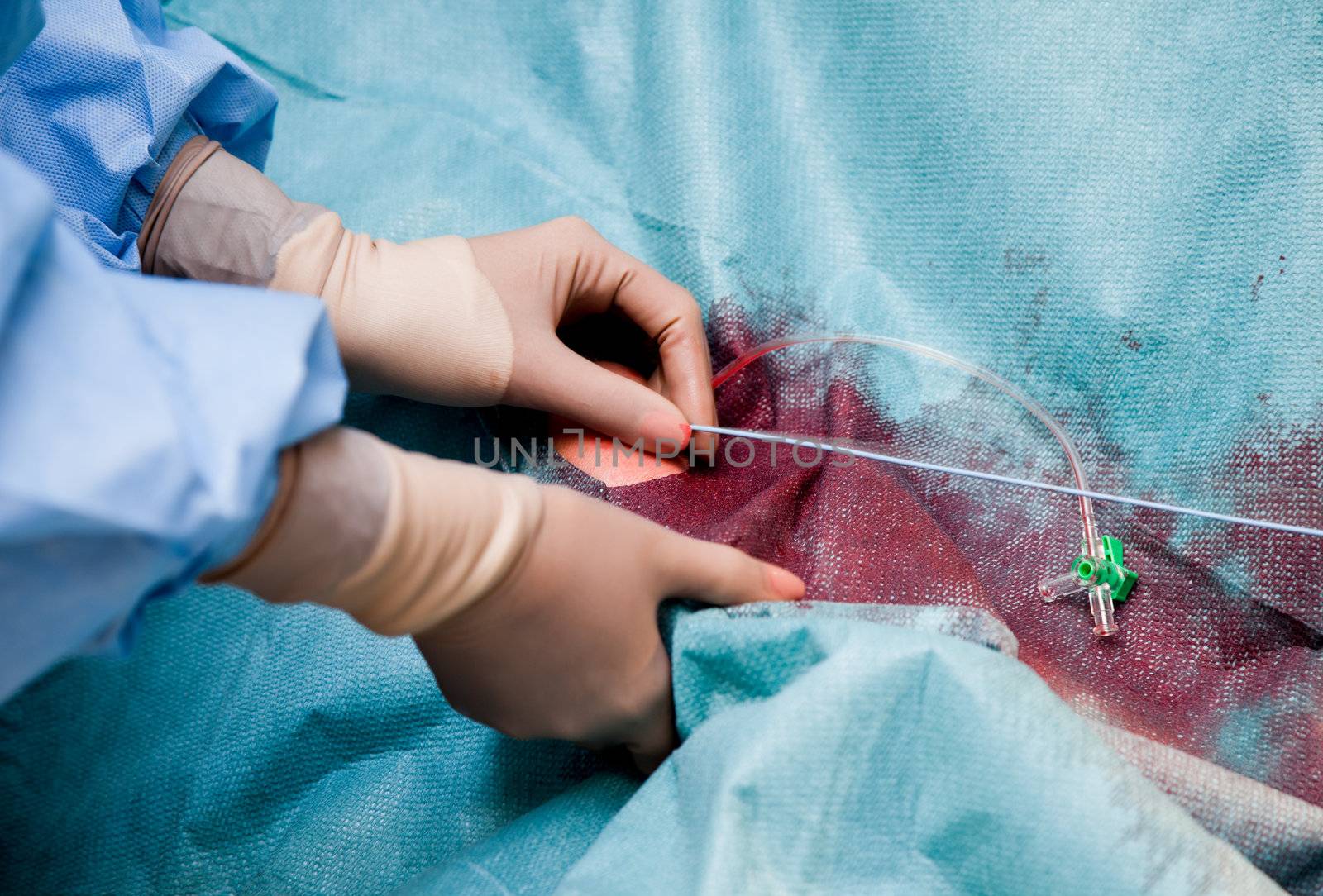 Close-up of hands with gloves placing coronarography catheter in patient