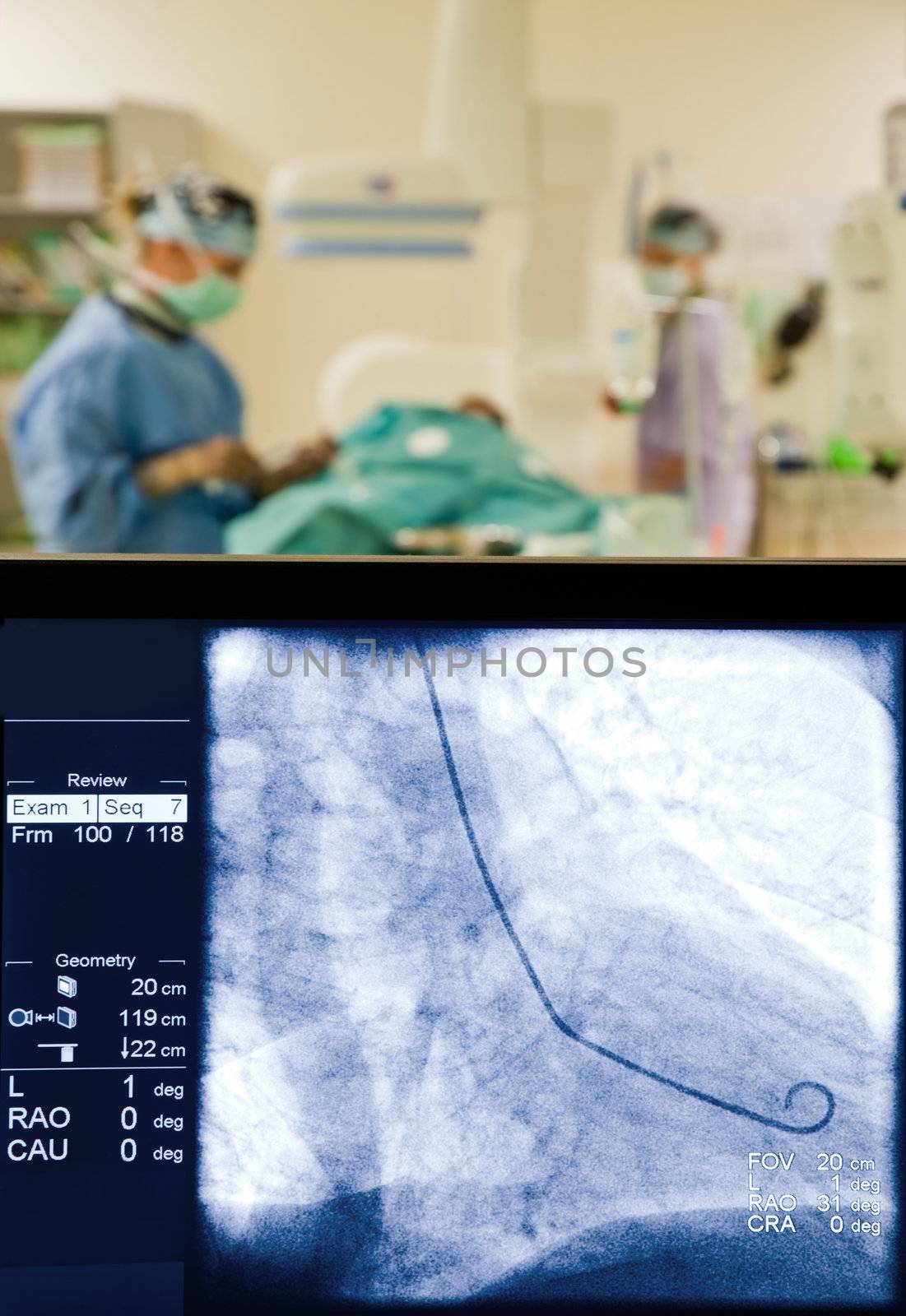 Medical team performng coronarography procedure, focus on x-ray screen
