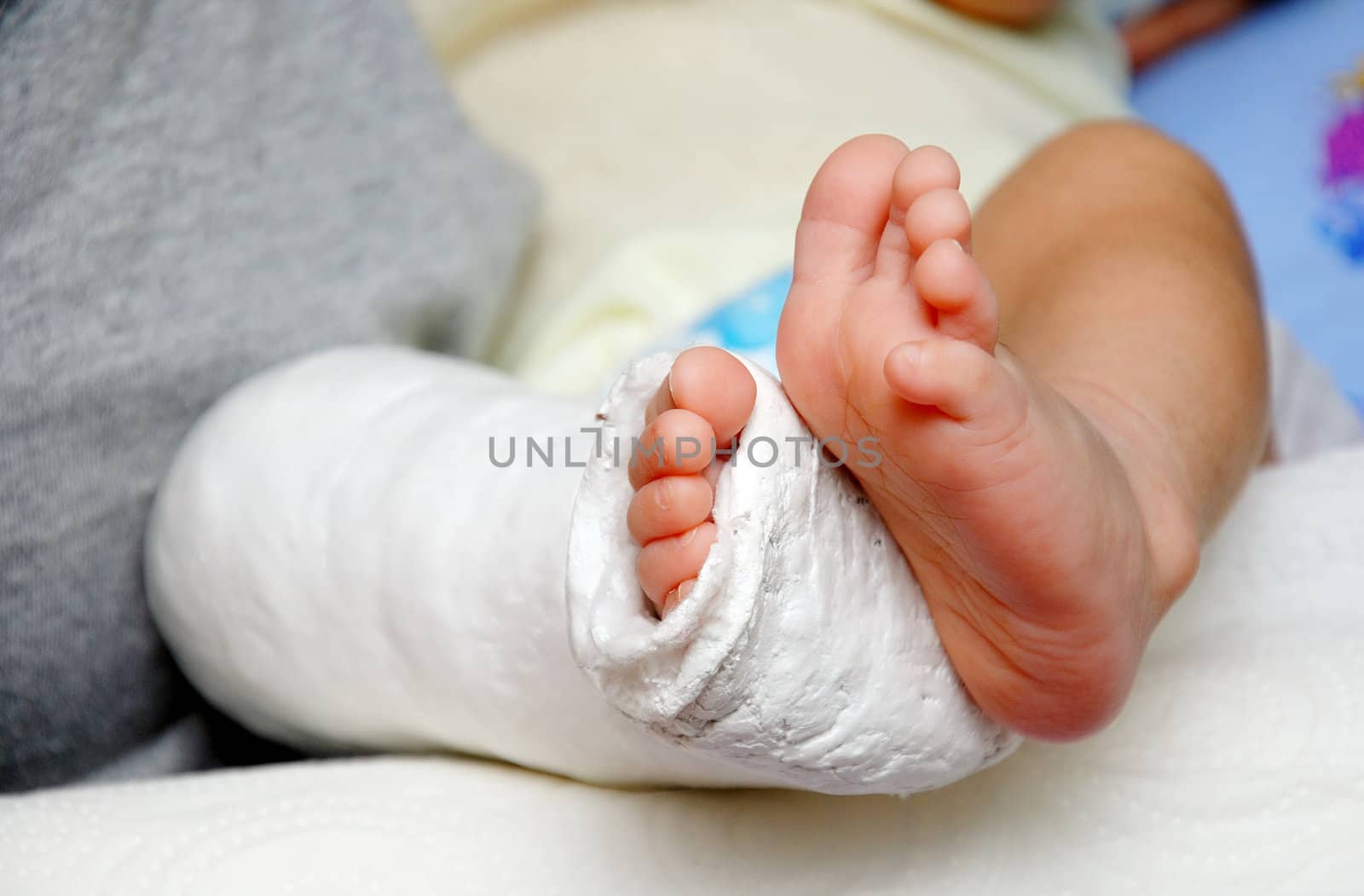 Baby foot in bandage and cast by bigjom