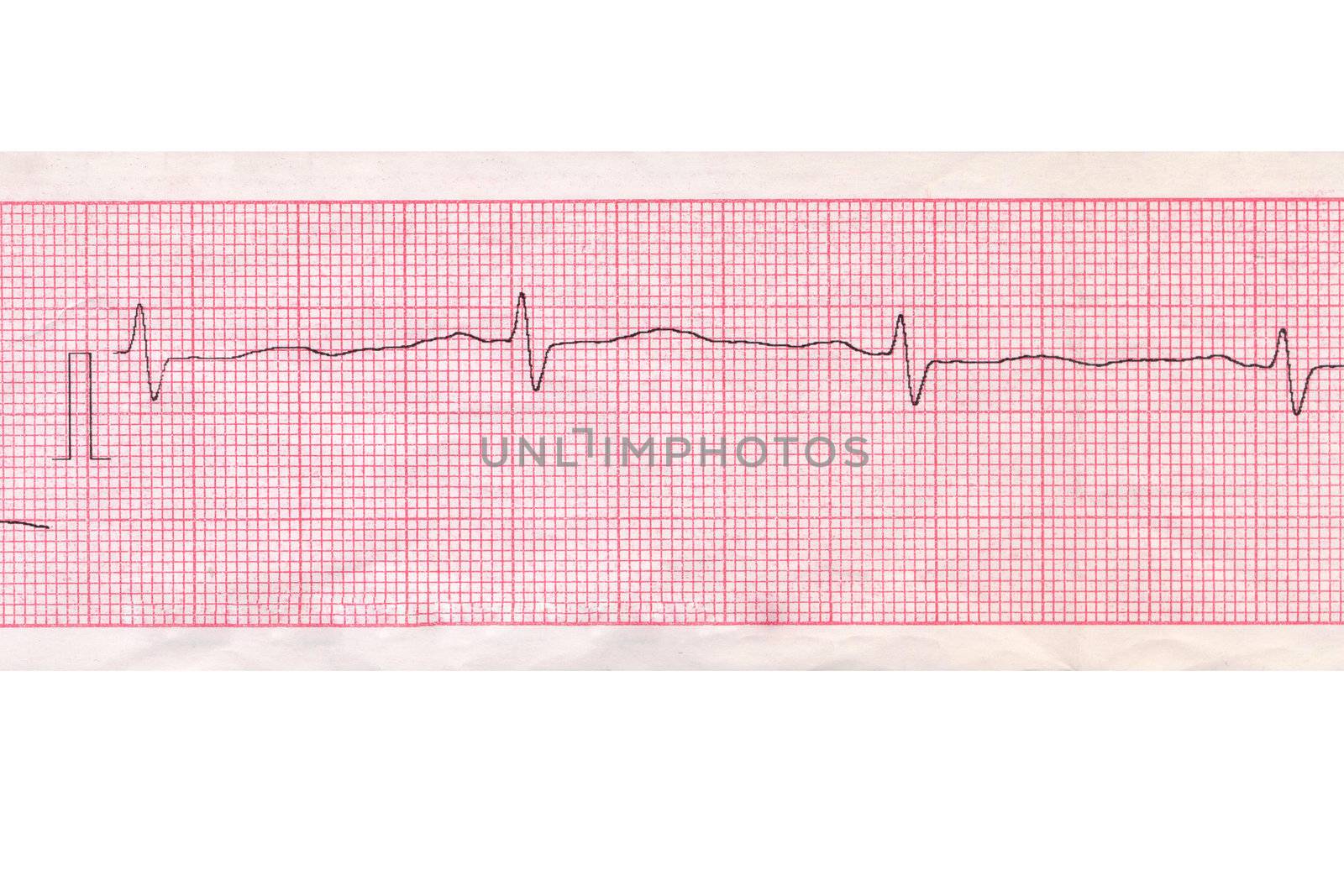 Heart analysis scheme  by petrkurgan