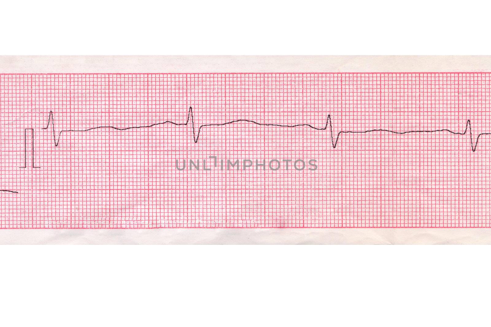 Medical inspection and health. Heart analysis scheme. Cardiogram 