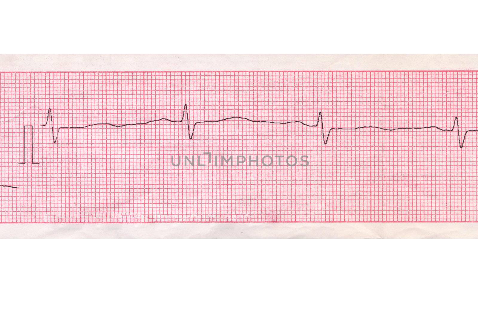 Medical inspection and health. Heart analysis scheme. Cardiogram 