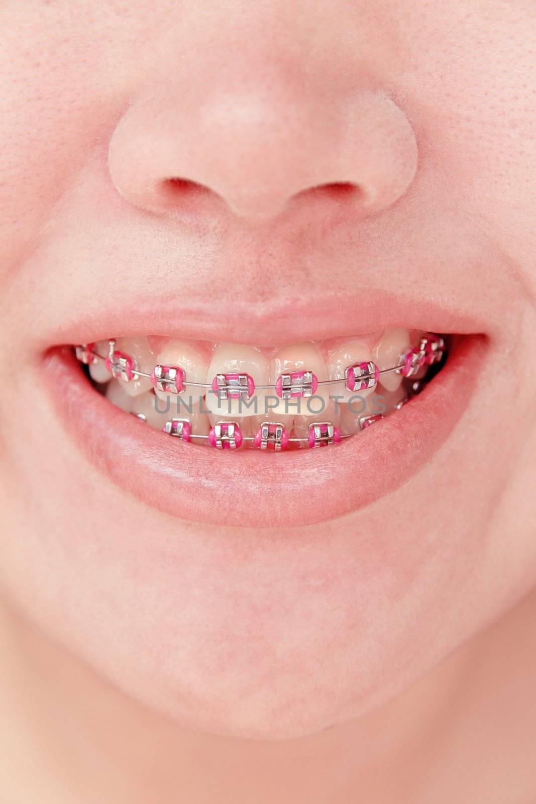 girl smiling with braces on teeth,dental concept