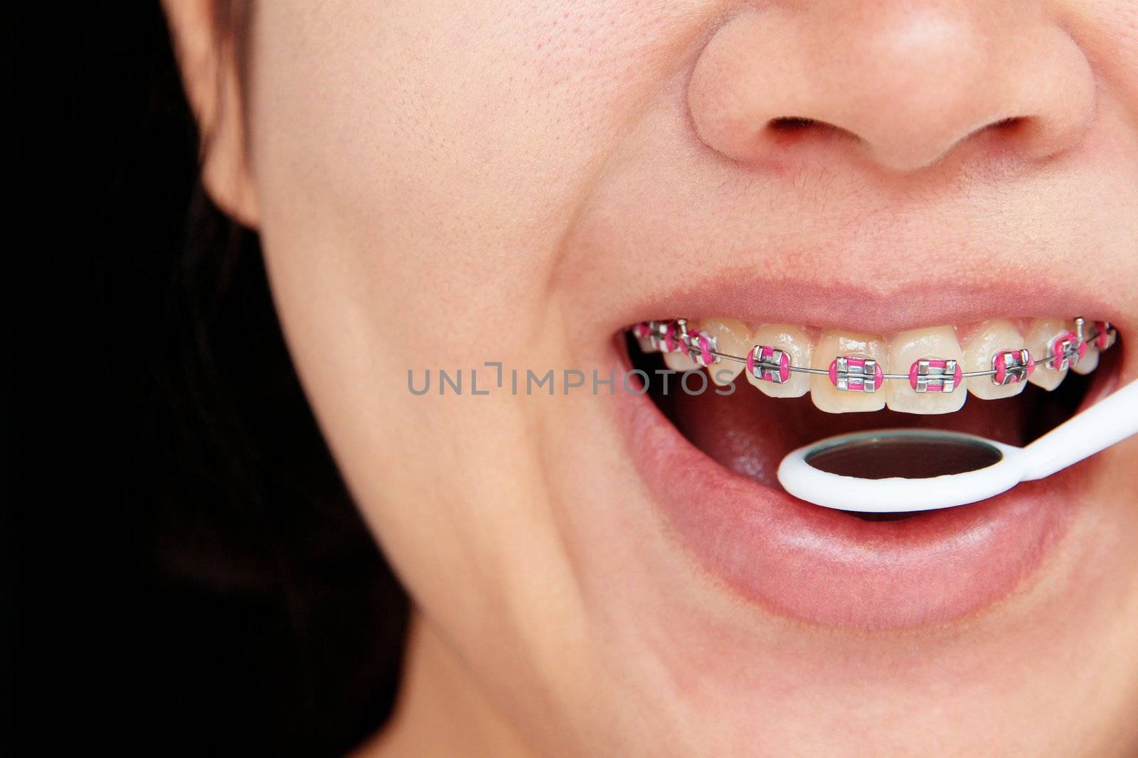 girl smiling with braces on teeth,dental concept